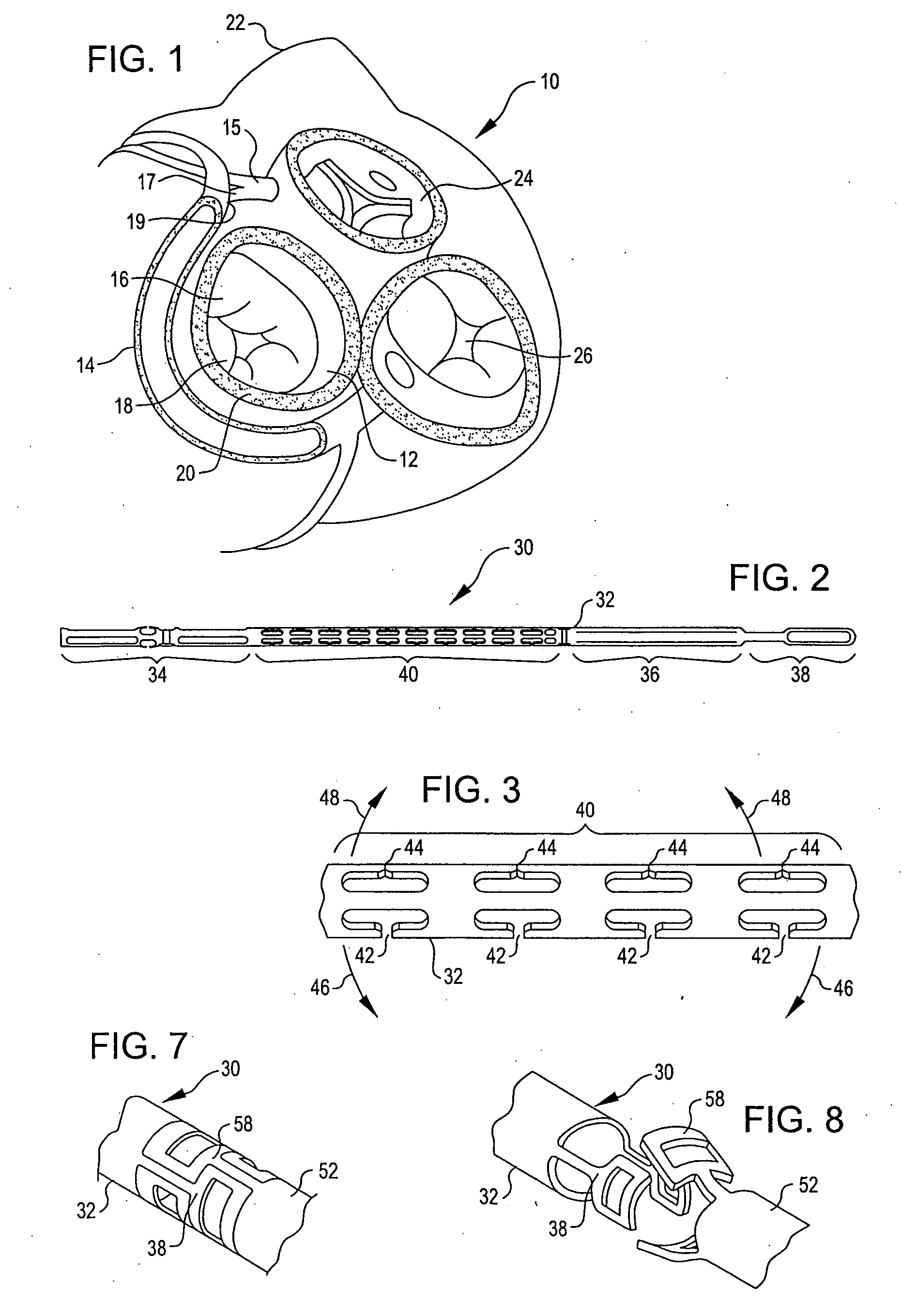 Device, assembly and method for mitral valve repair