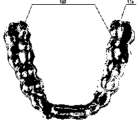 Invisible malocclusion appliance with drainage holes