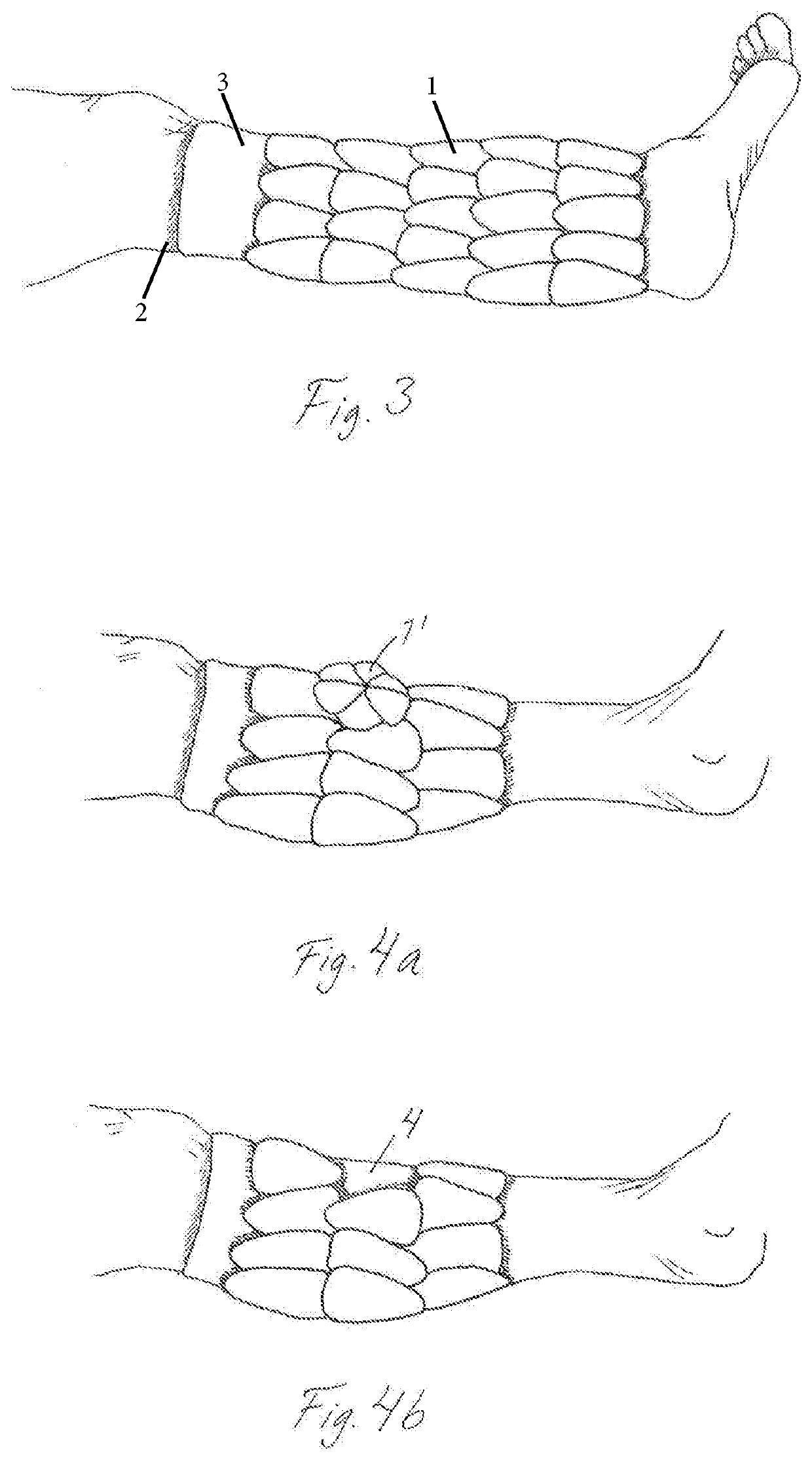 A Kit And Therapeutic Pressure Assembly With Patches For Applying Pressure To A Limb Or Other Body Part