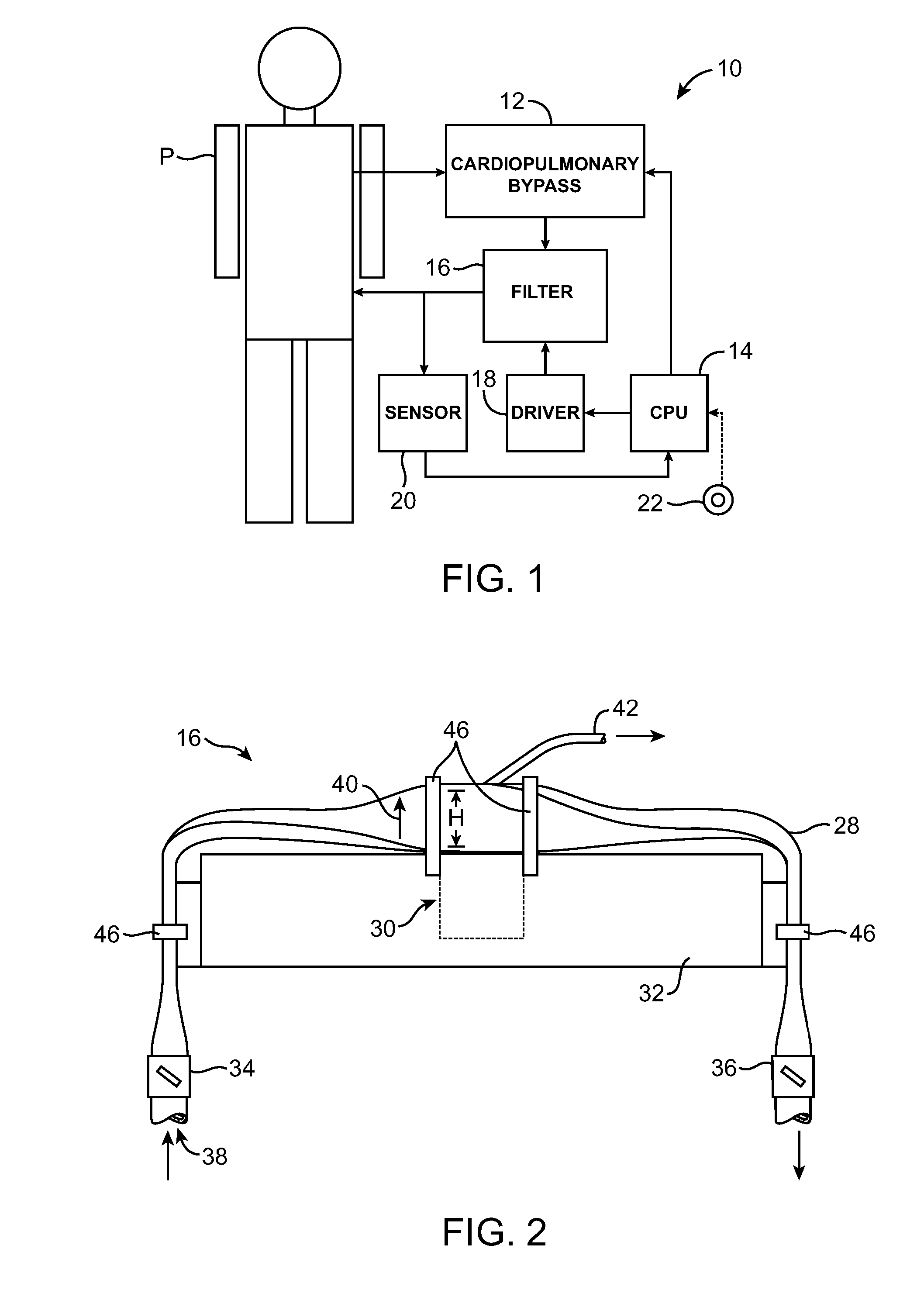 Ultrasonic Material Removal System for Cardiopulmonary Bypass and Other Applications