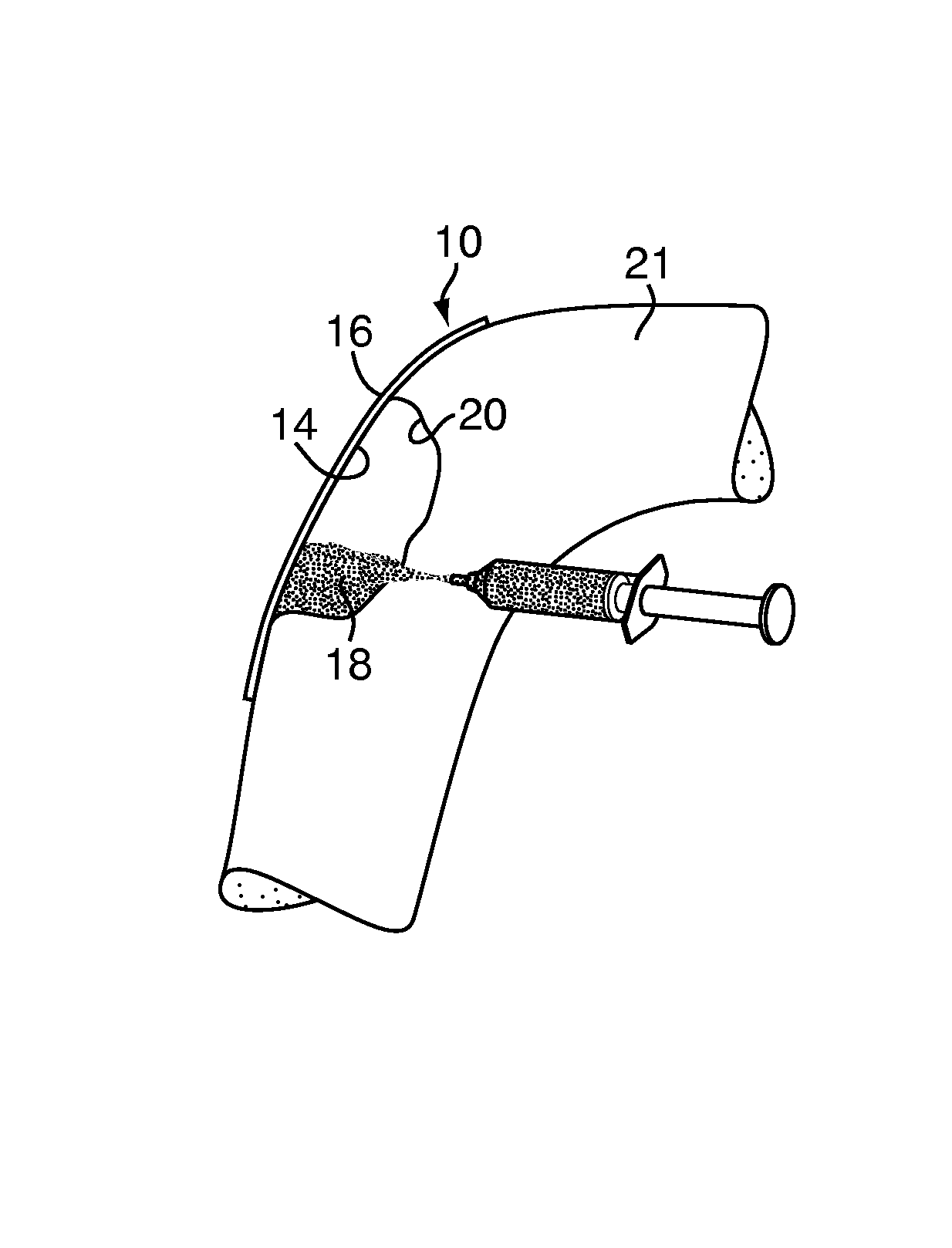 Method and device for handling bone adhesives