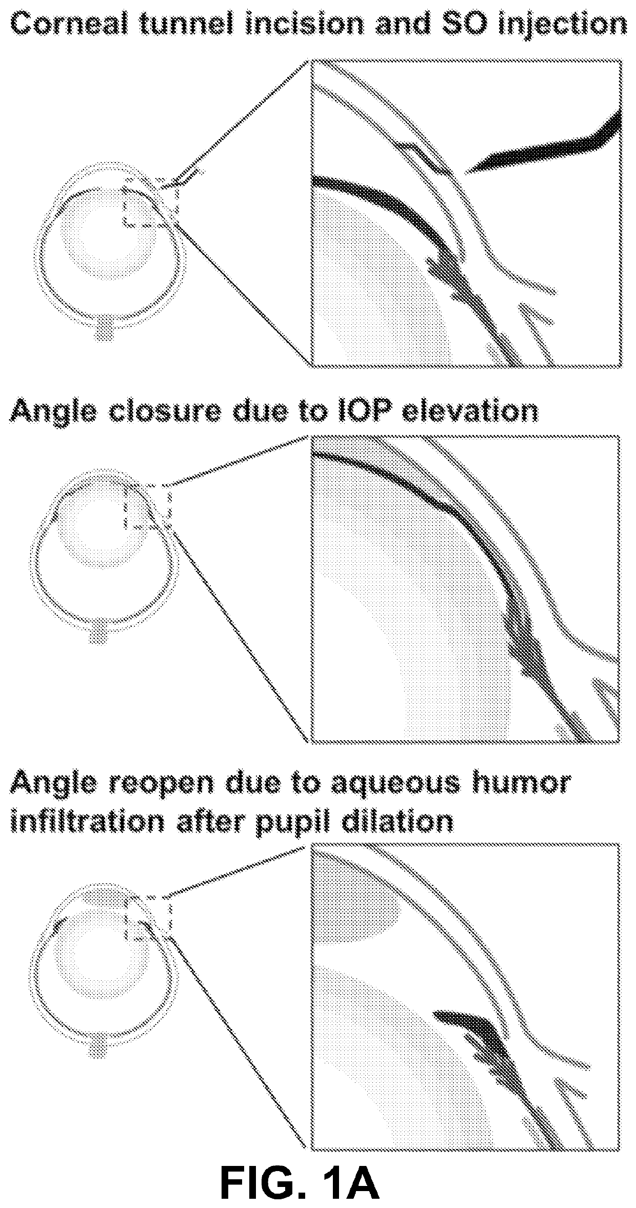 Silicone Oil-Induced Ocular Hypertension Glaucoma Model