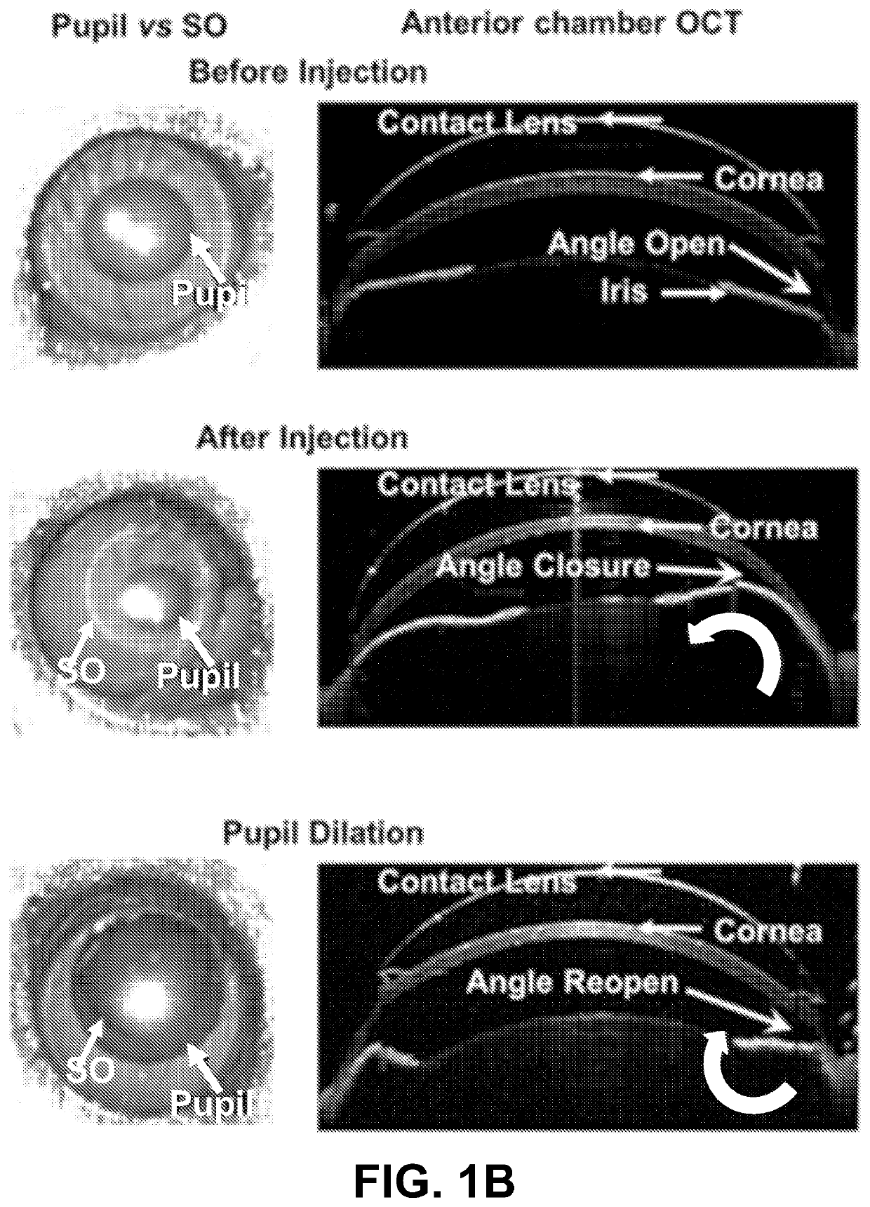 Silicone Oil-Induced Ocular Hypertension Glaucoma Model