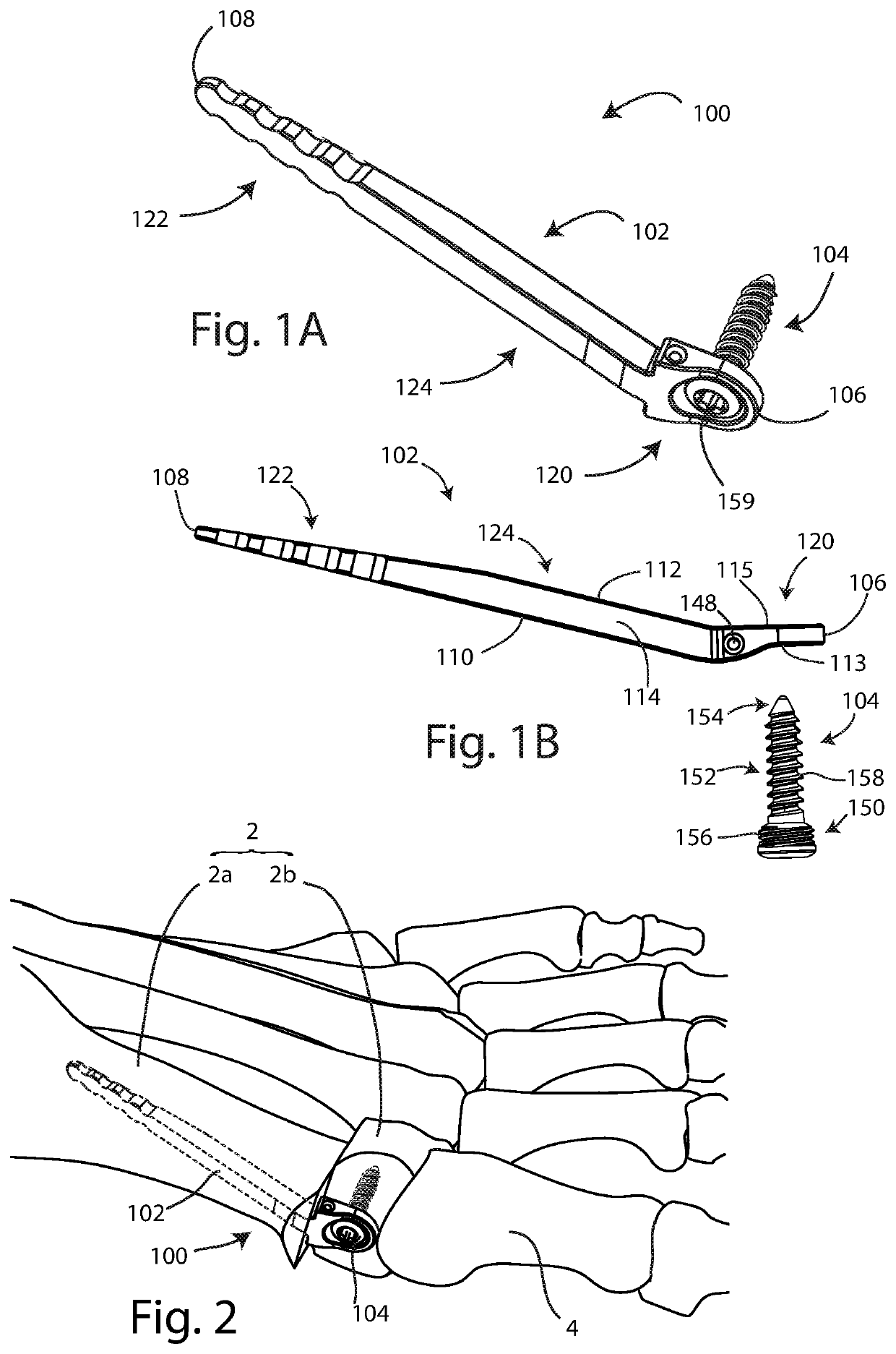 Bunion correction system and method