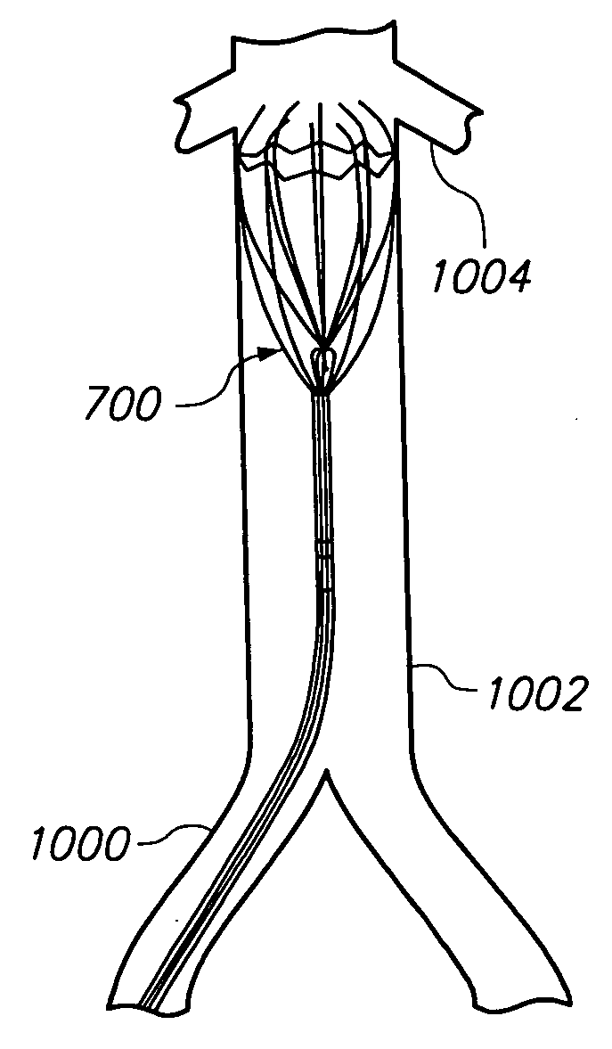 Removable vascular filter and method of filter placement