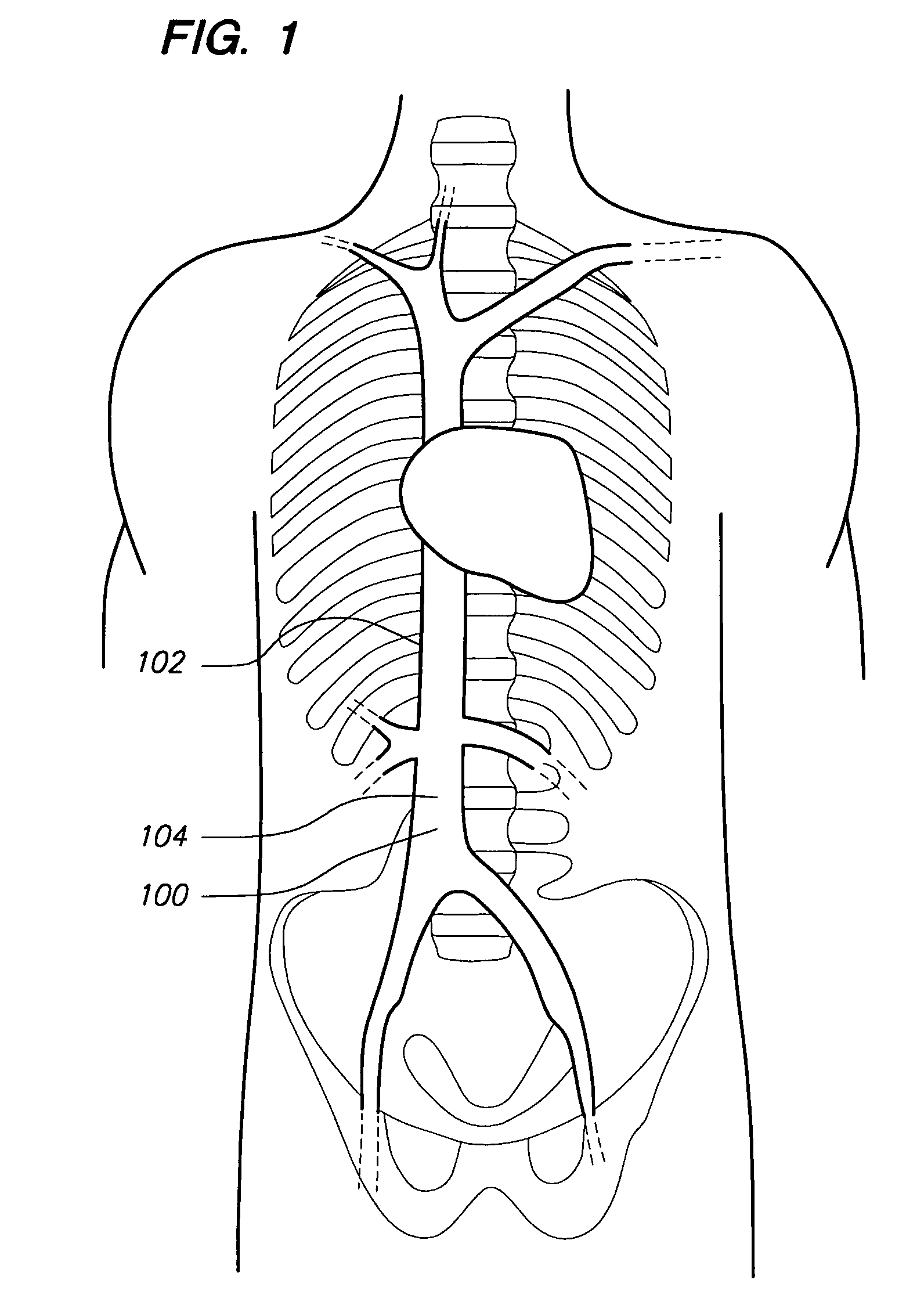 Removable vascular filter and method of filter placement