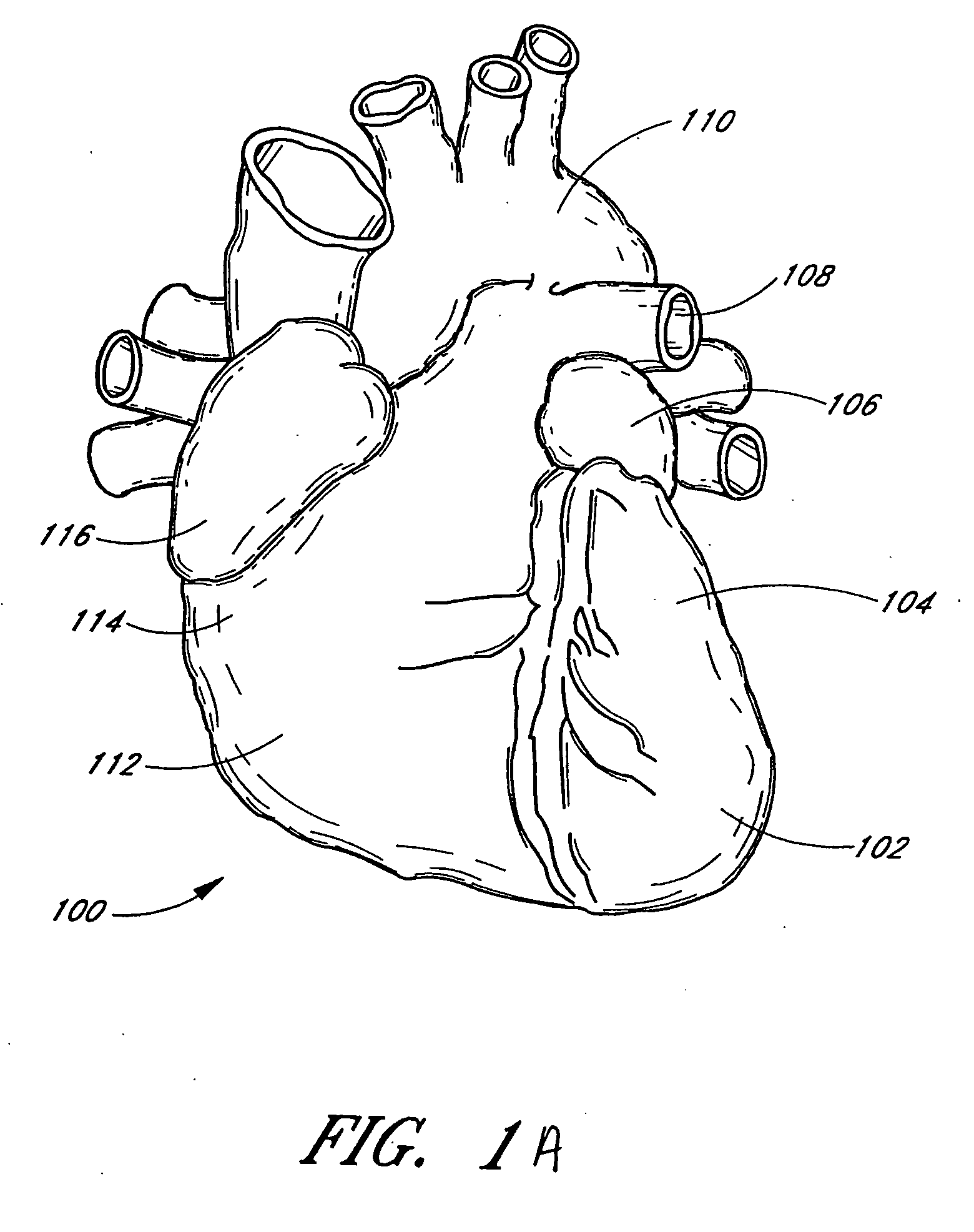 Intracardiac cage and method of delivering same
