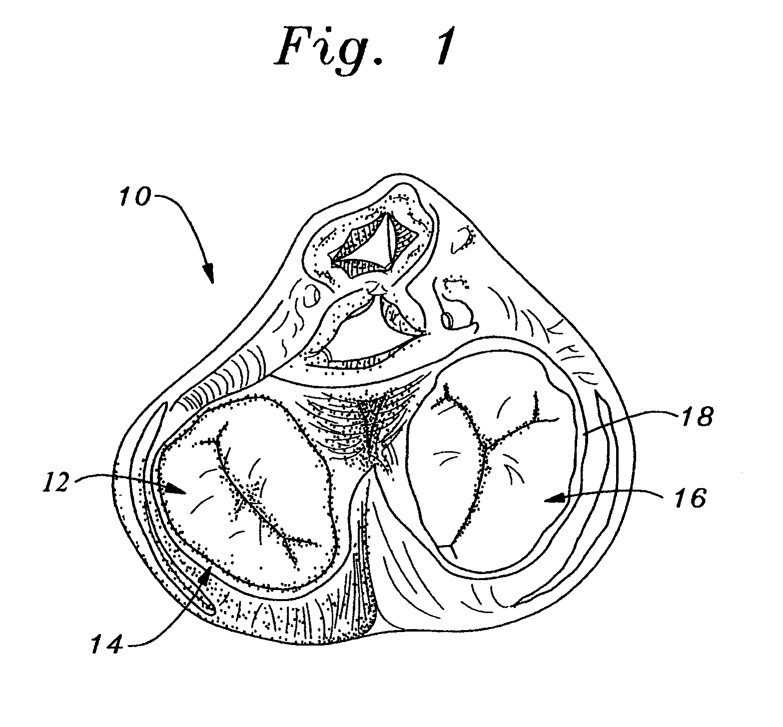Method of implanting a self-molding annuloplasty ring