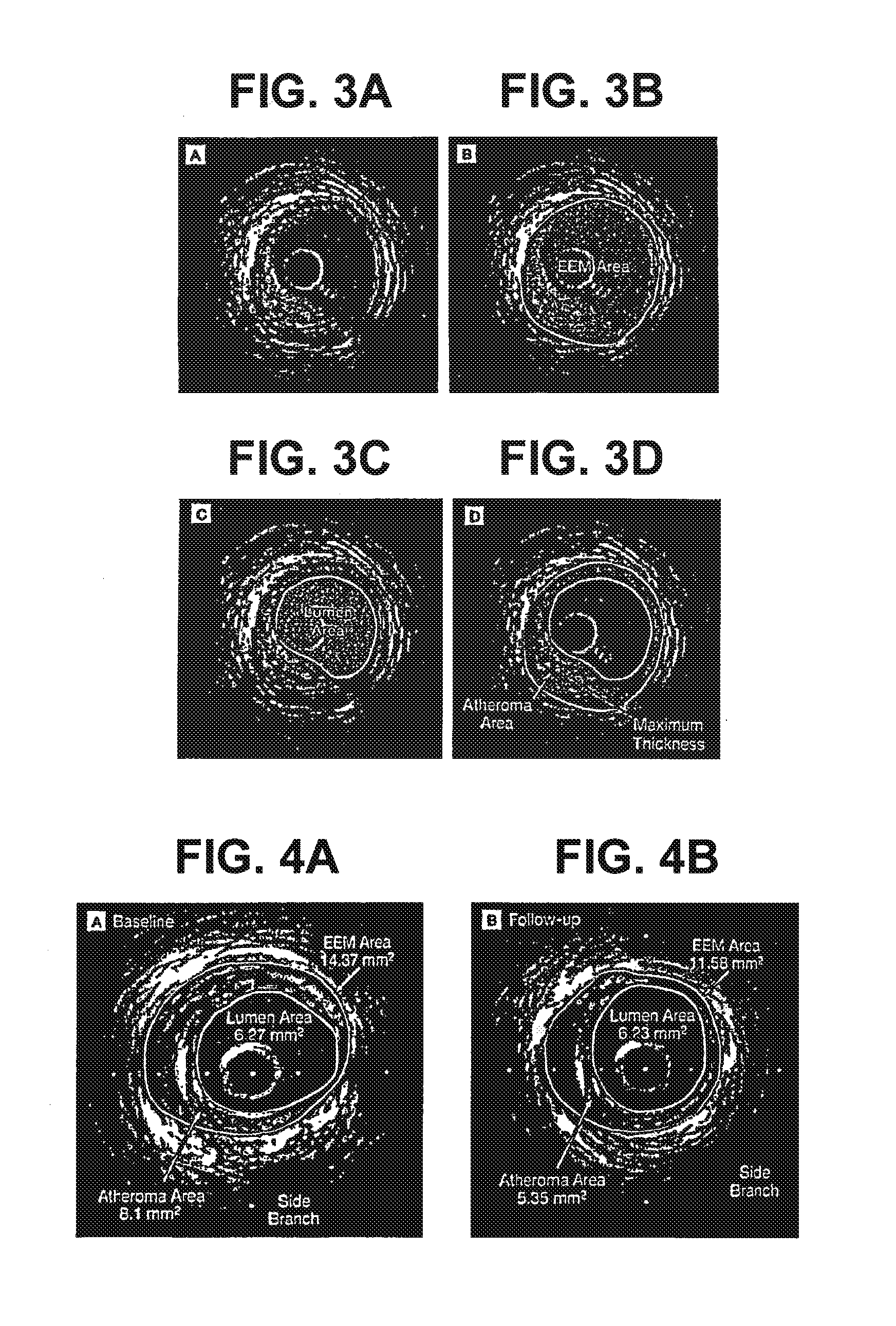 Pharmaceutical formulations, methods, and dosing regimens for the treatment and prevention of acute coronary syndromes