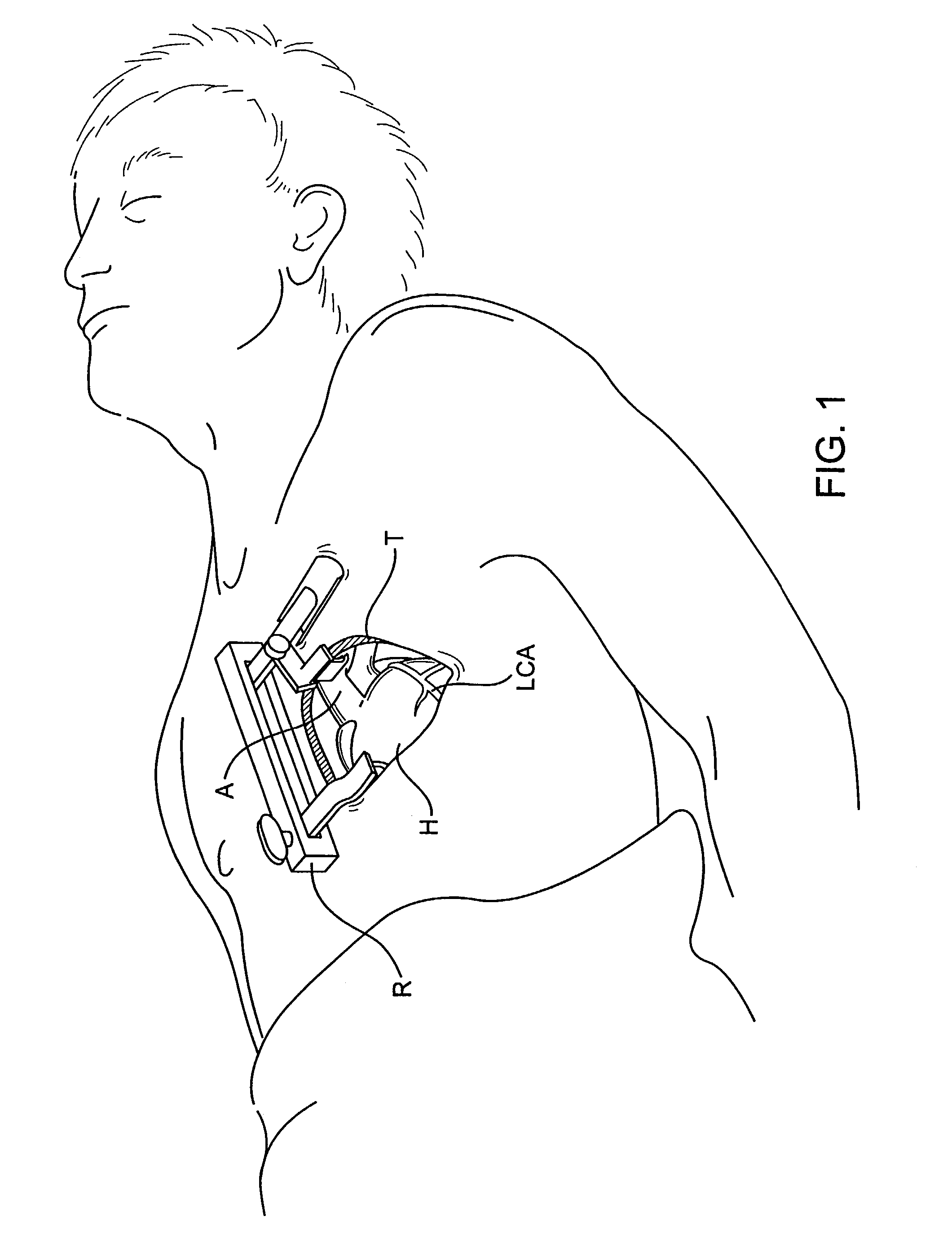 Delivering a conduit into a heart wall to place a coronary vessel in communication with a heart chamber and removing tissue from the vessel or heart wall to facilitate such communication