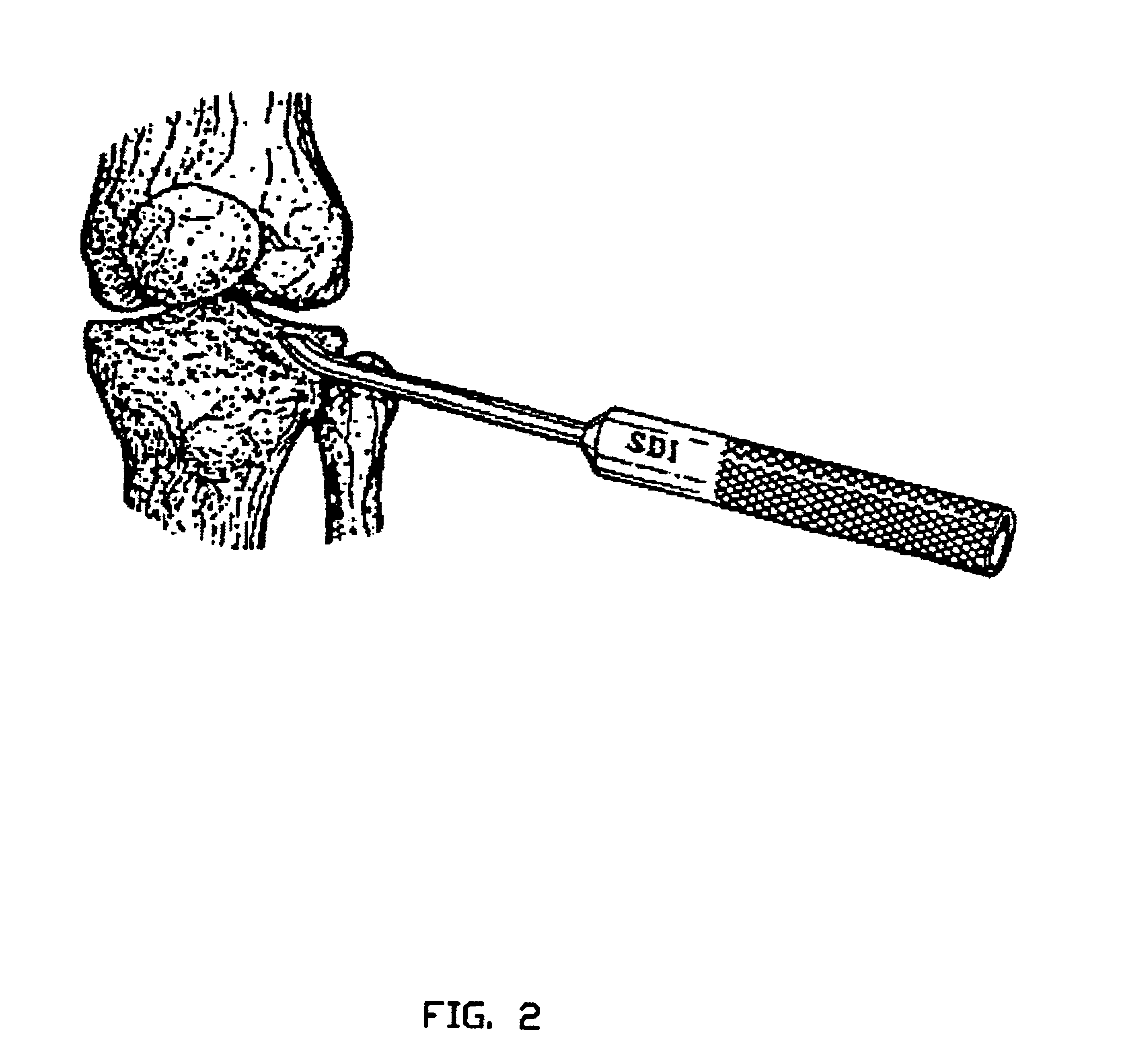 Process and instrumentation for arthroscopic reduction of central and peripheral depression fractures