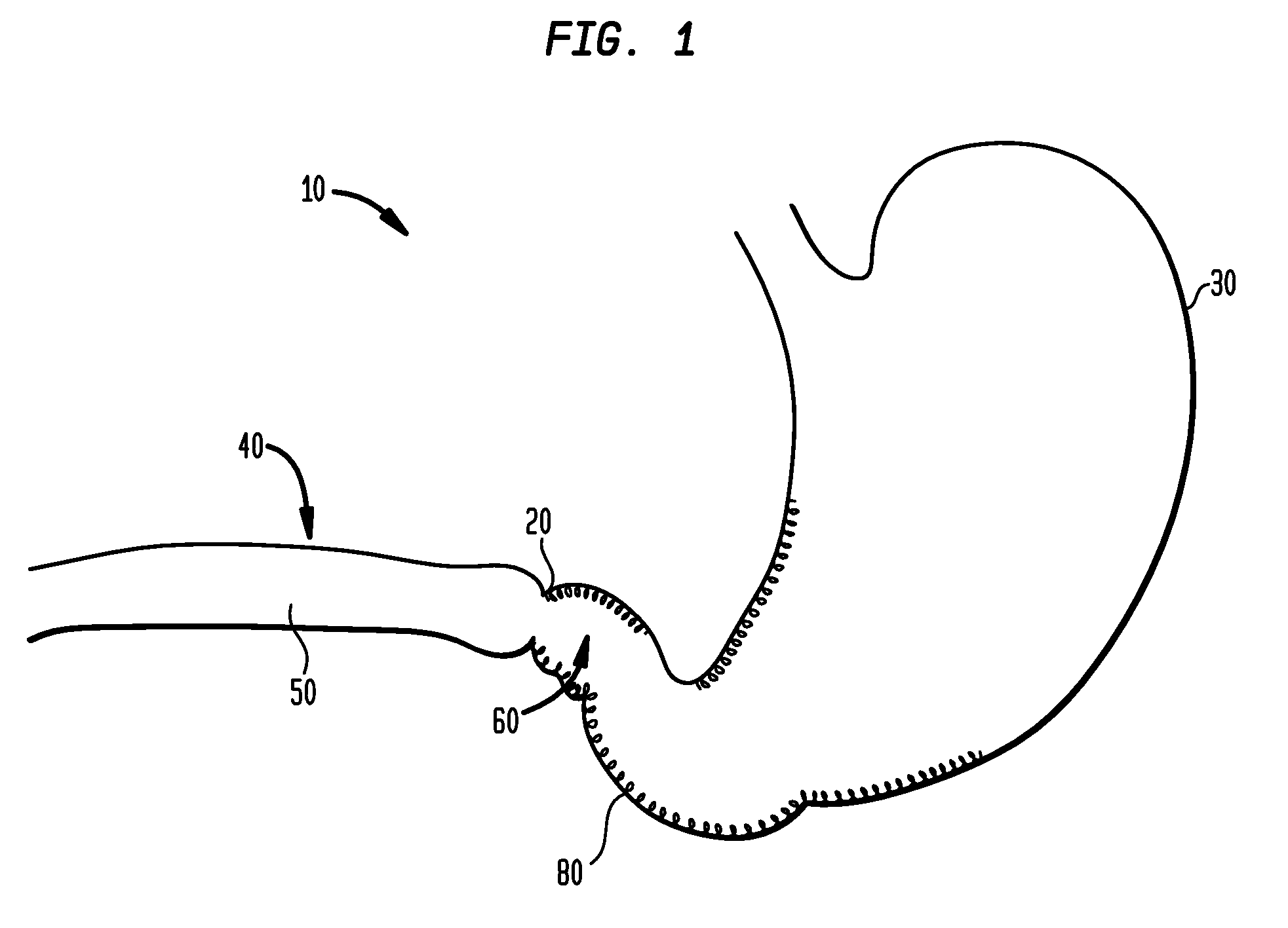 Systems and Methods for Treating Obesity and Type 2 Diabetes
