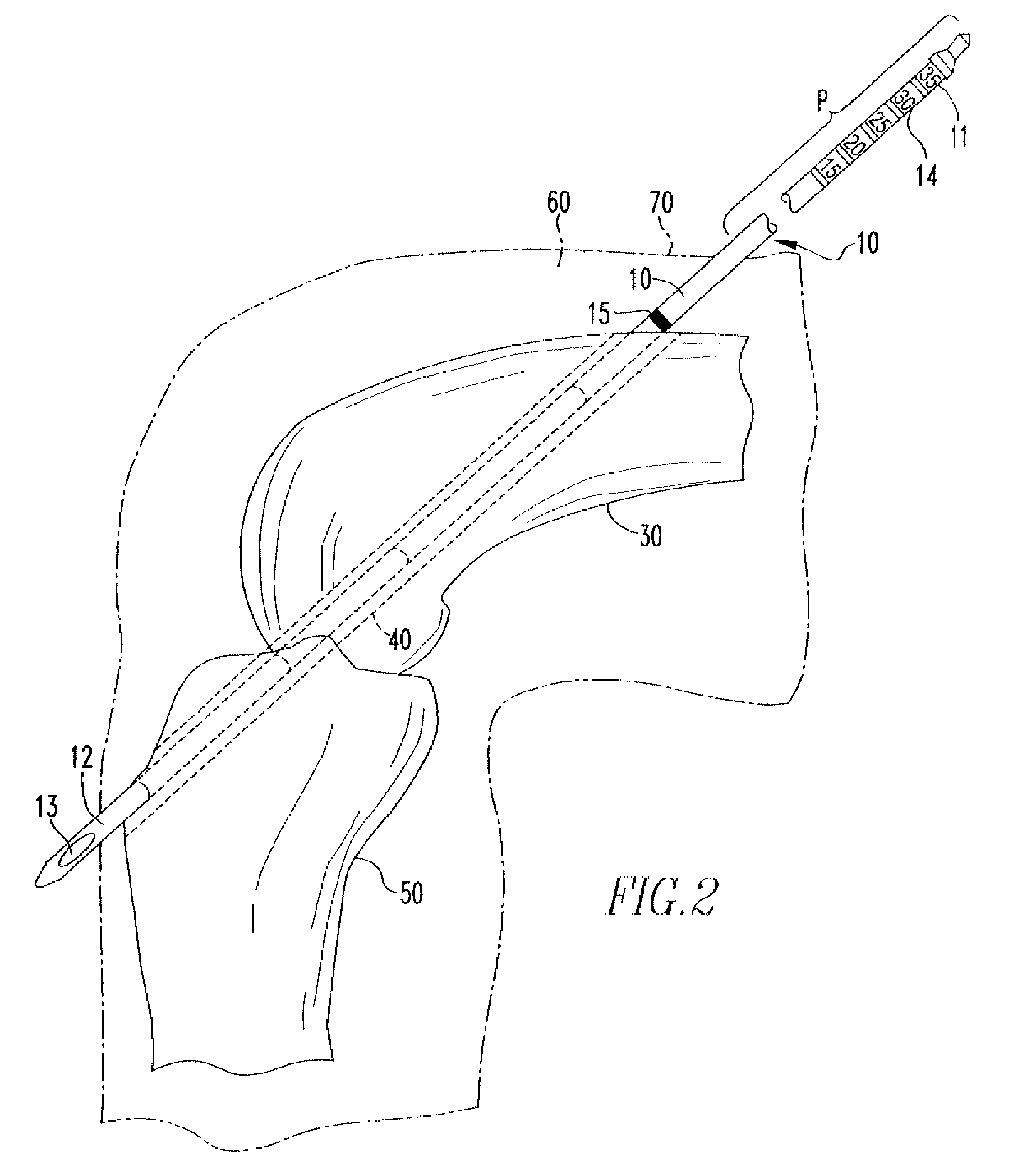 Device And Method For Use During Ligament Reconstruction Surgery