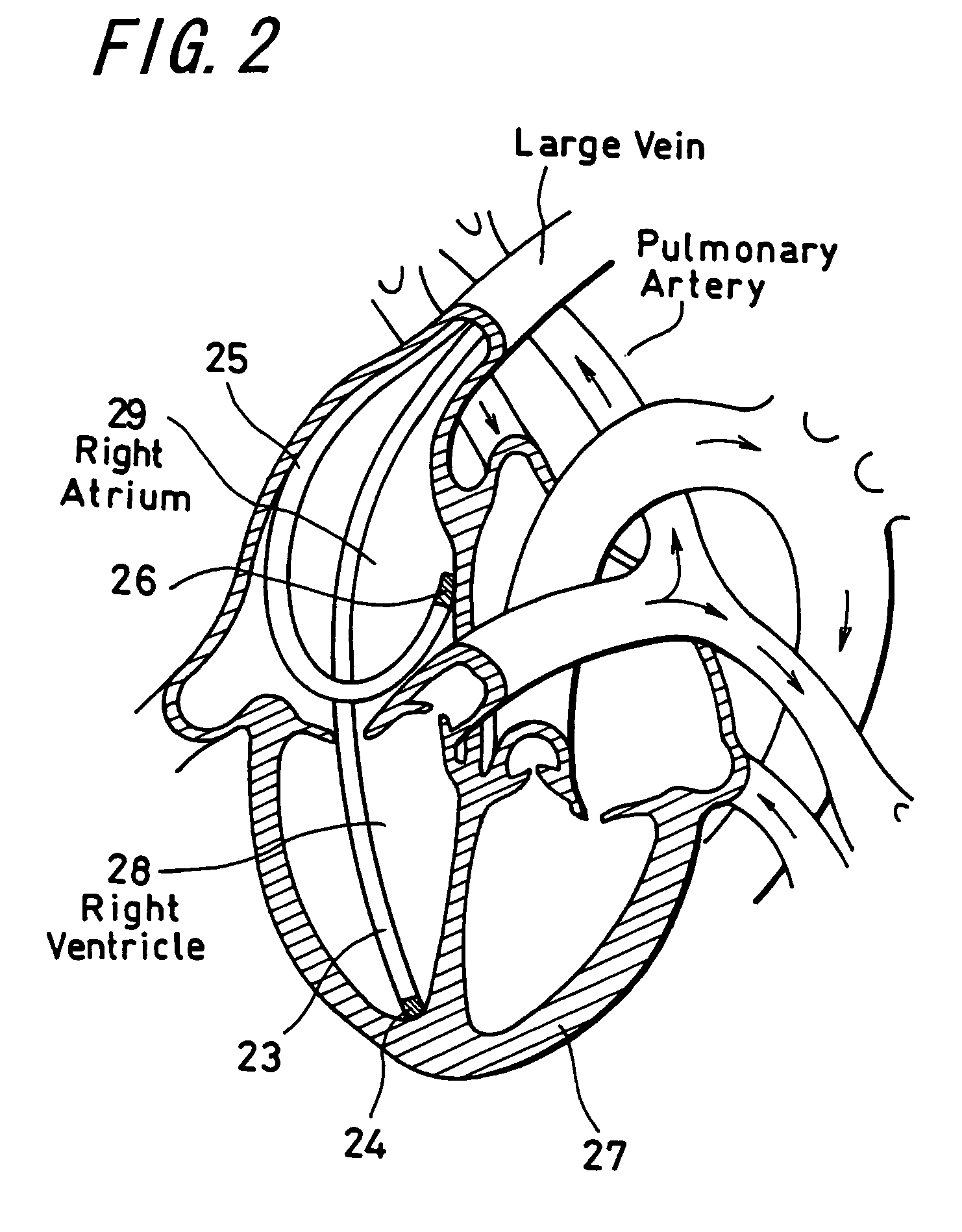 Heart treatment equipment and heart treatment method