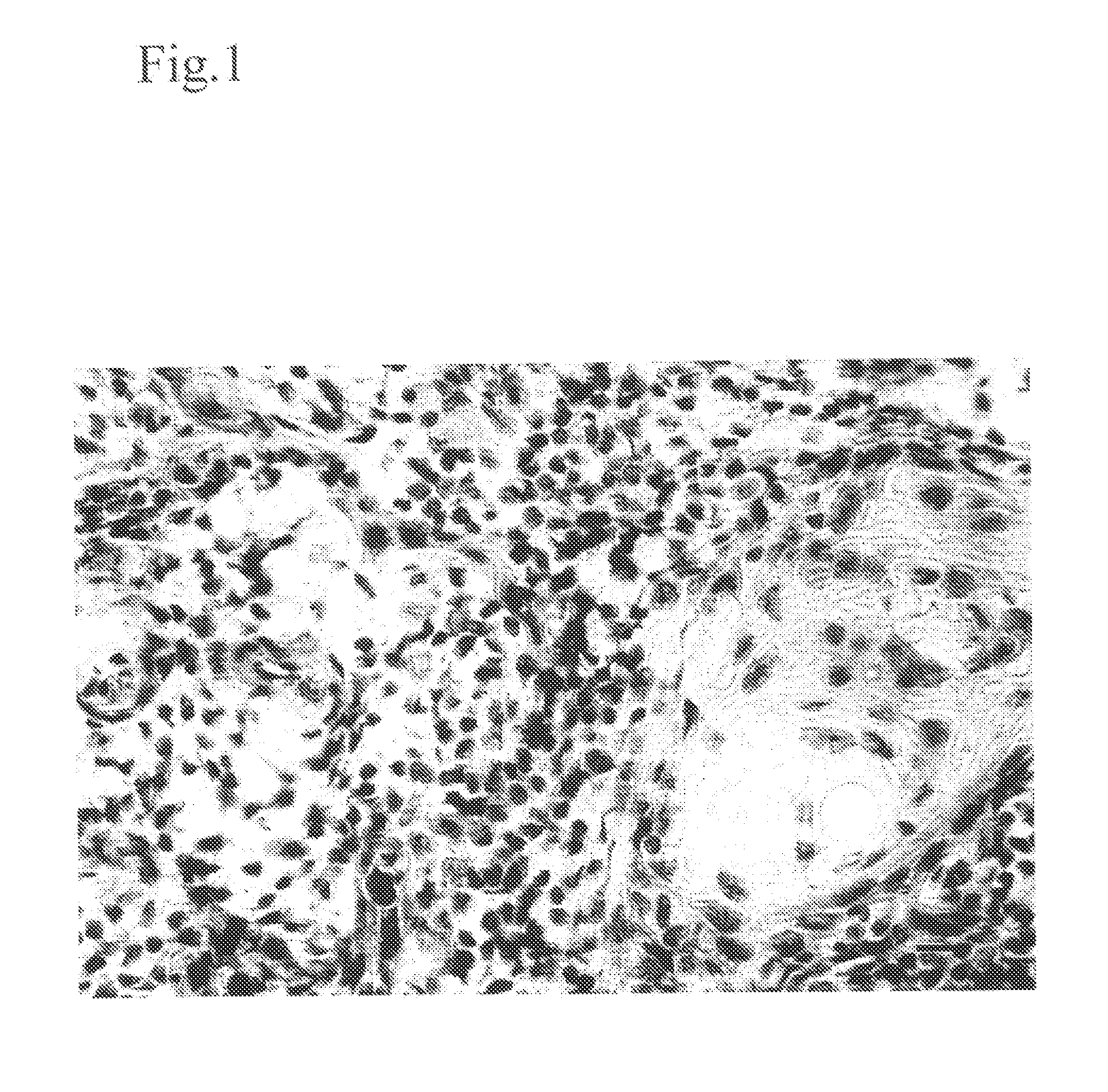 Method for modulating HLA class ii tumor cell surface expression with a cytokine mixture