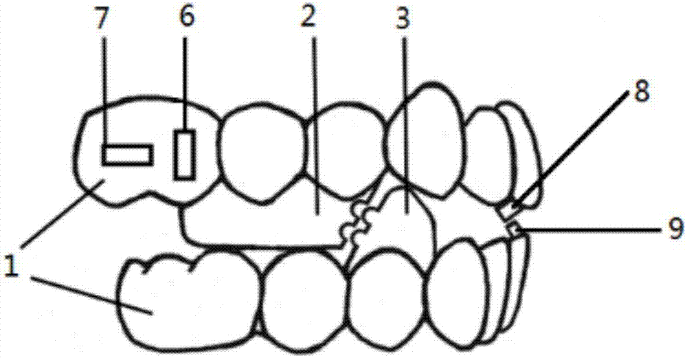 Invisible mandibular advancement orthotic method and invisible orthotic apparatus based on same