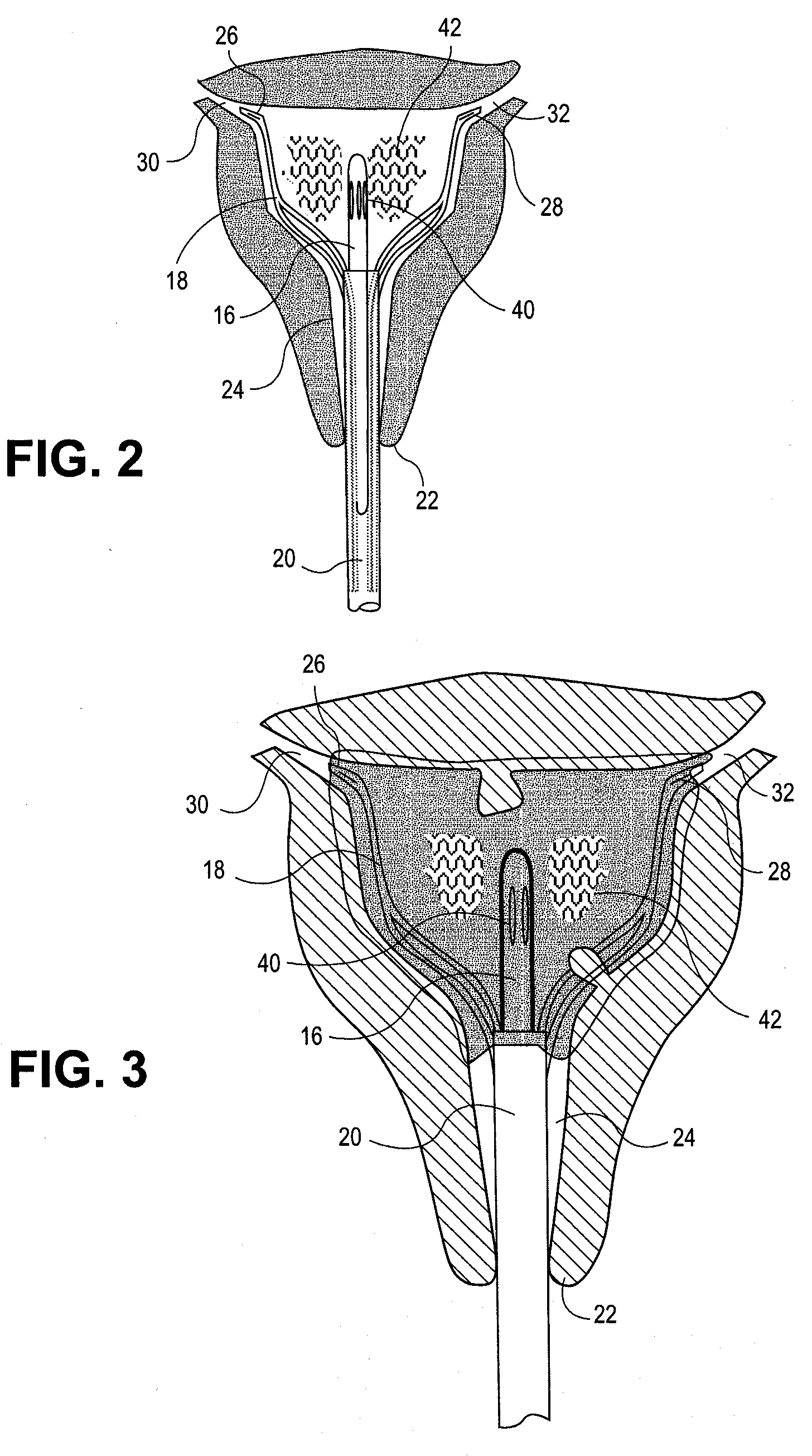 Uterine Therapy Device and Method