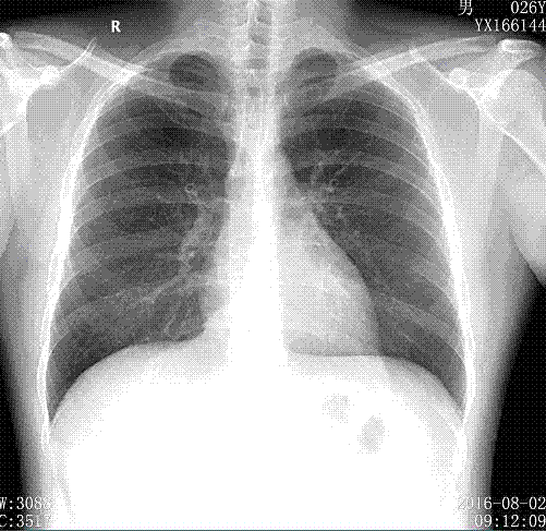DR (direct digital radiograph) dual-energy subtraction high-KV (kilovolt) chest radiography method for pneumoconiosis diagnosis