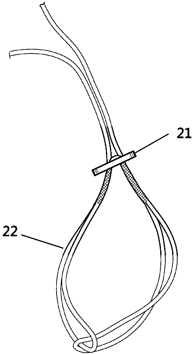 A fixation system for tibiofibular separation
