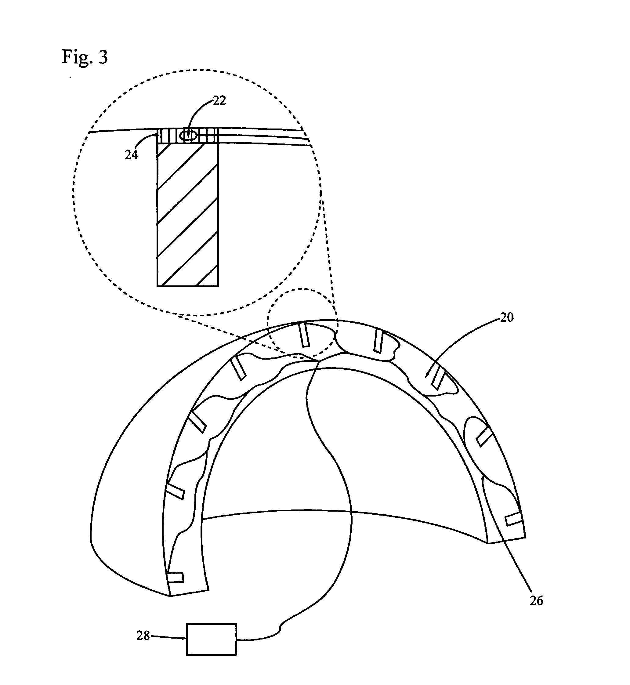 Acetabular cup with controlled release of an osteoinductive formulation