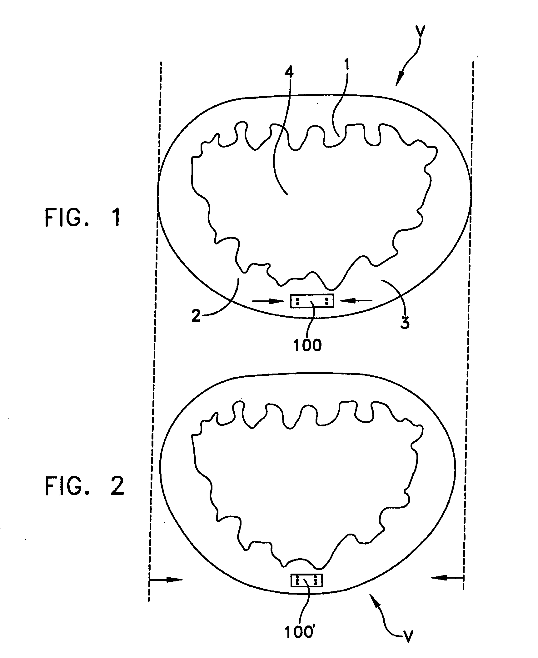 Automated annular plication for mitral valve repair