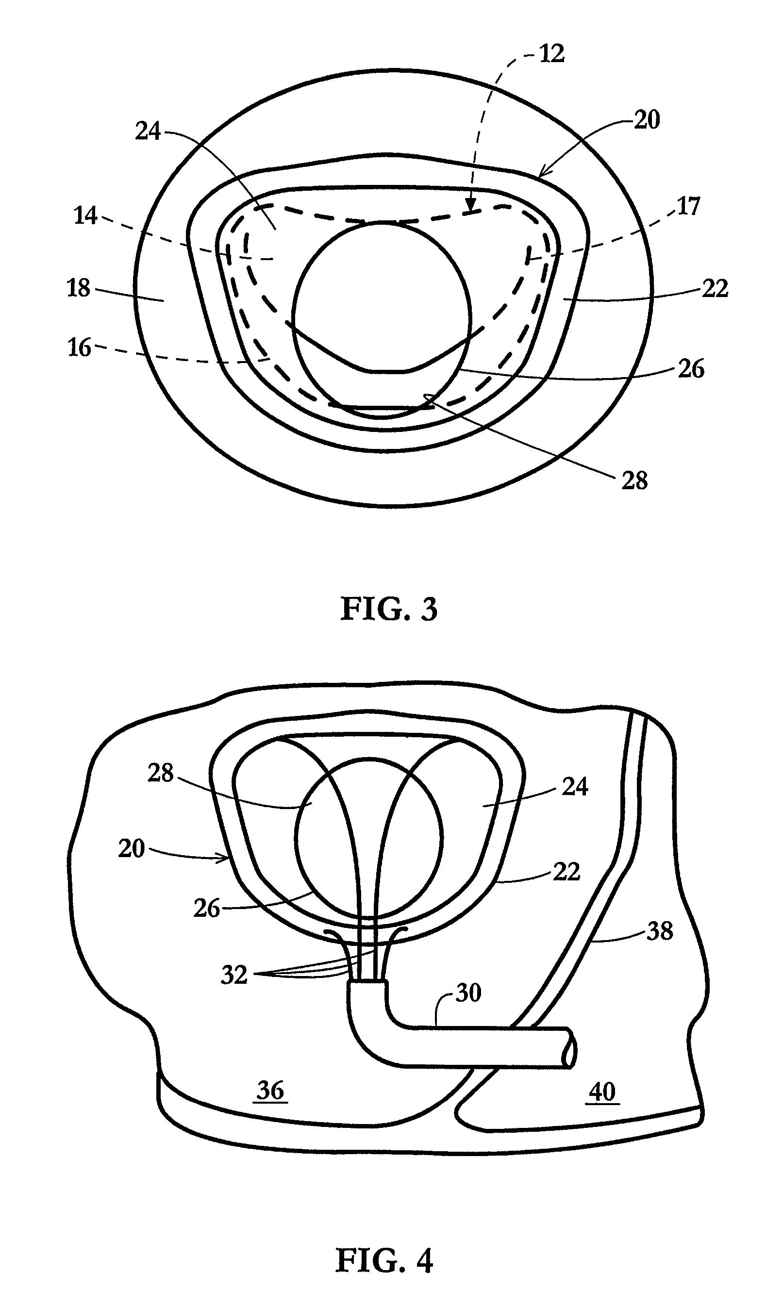 Device and method for temporary or permanent suspension of an implantable scaffolding containing an orifice for placement of a prosthetic or bio-prosthetic valve