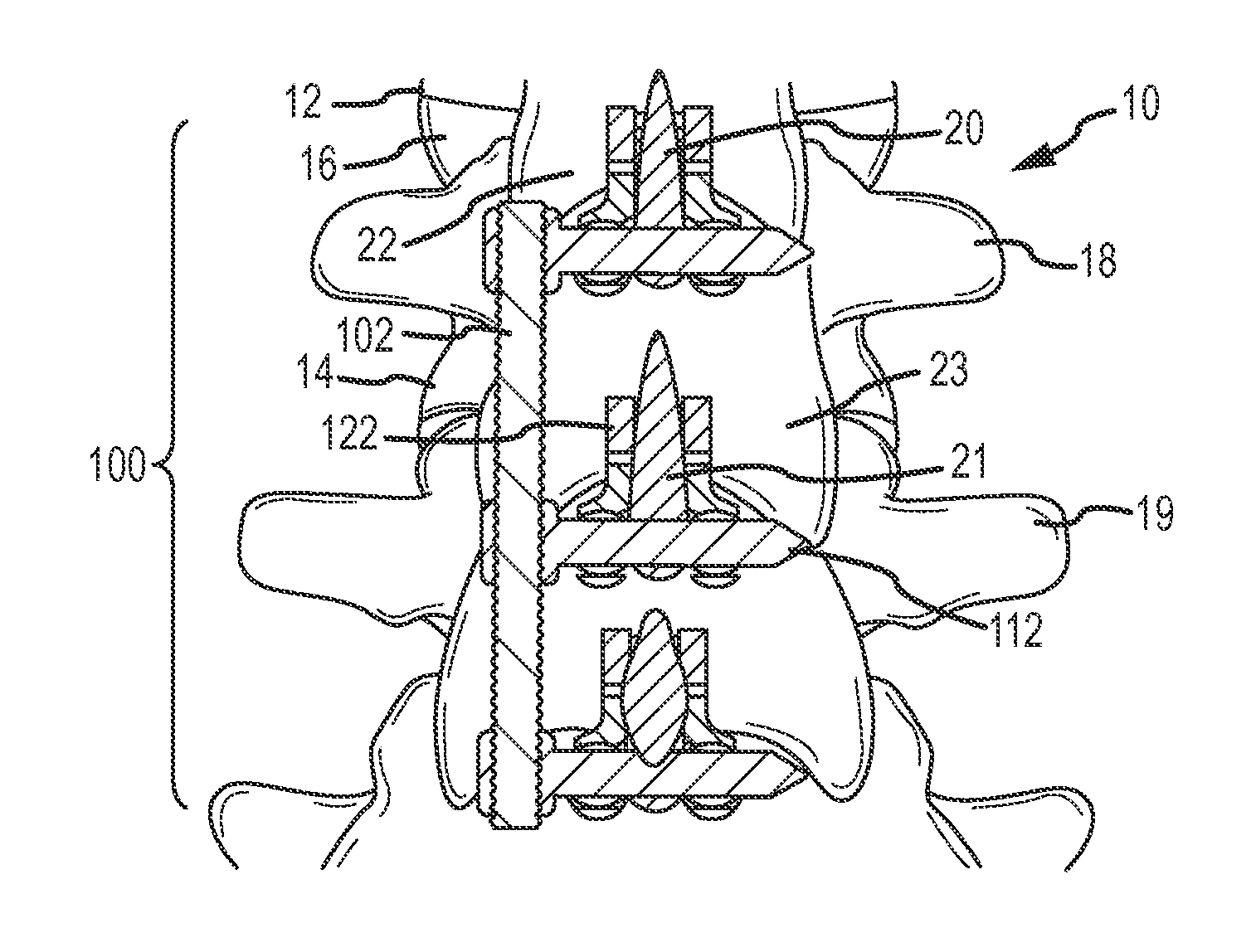 Segmental Spinous Process Anchor System and Methods of Use