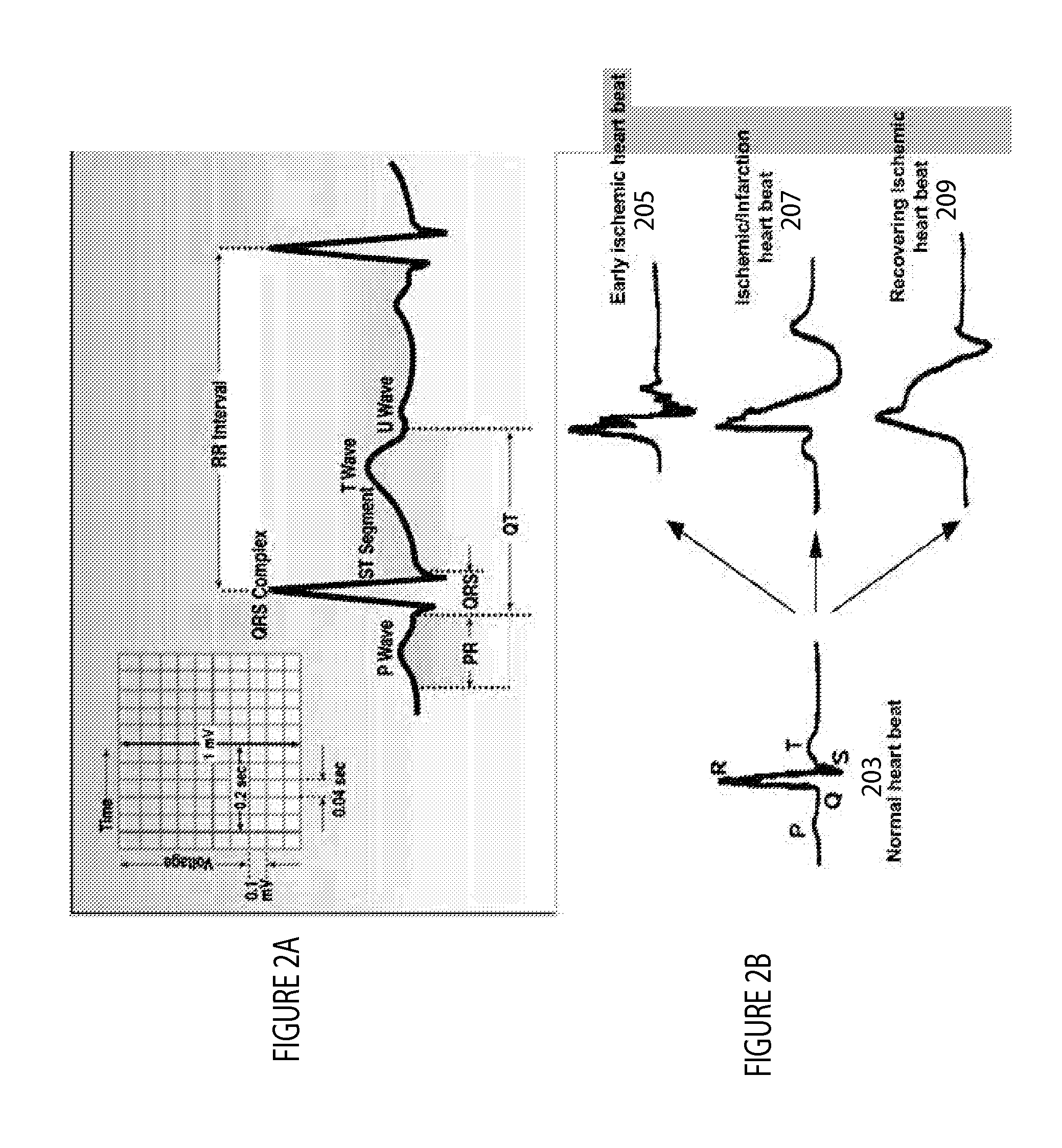 System for cardiac impairment detection based on signal regularity