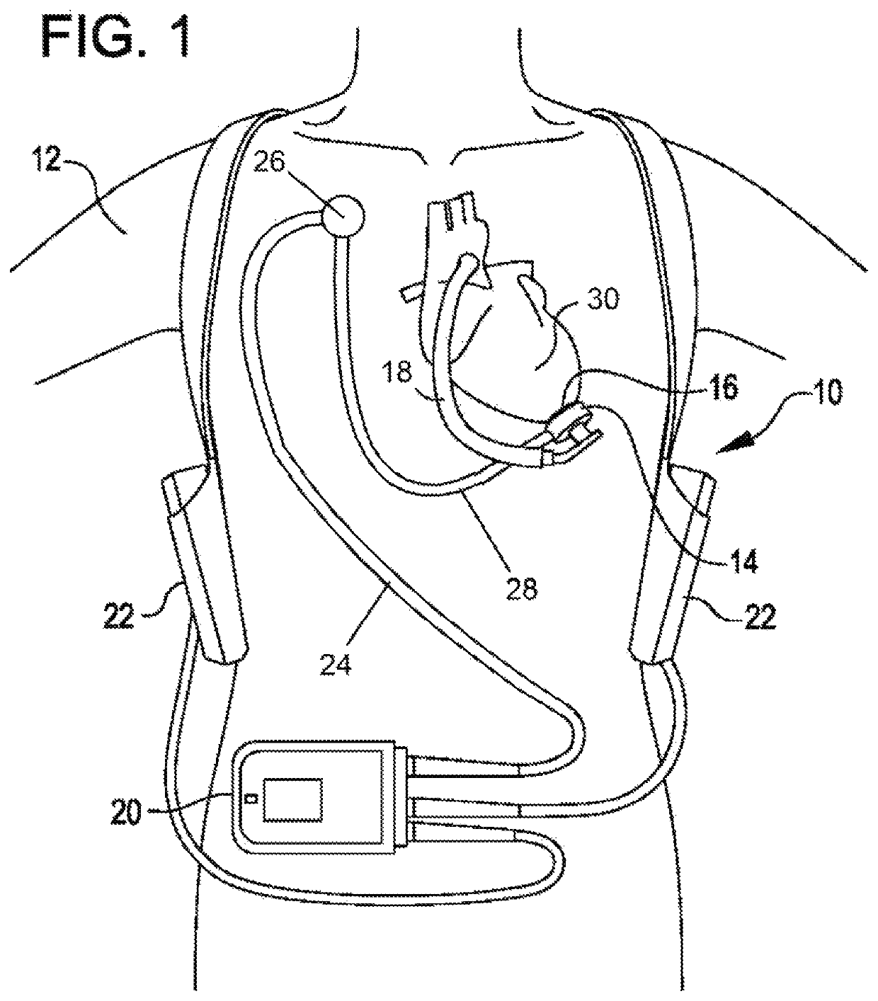 Prosthetic rib with integrated percutaneous connector for ventricular assist devices