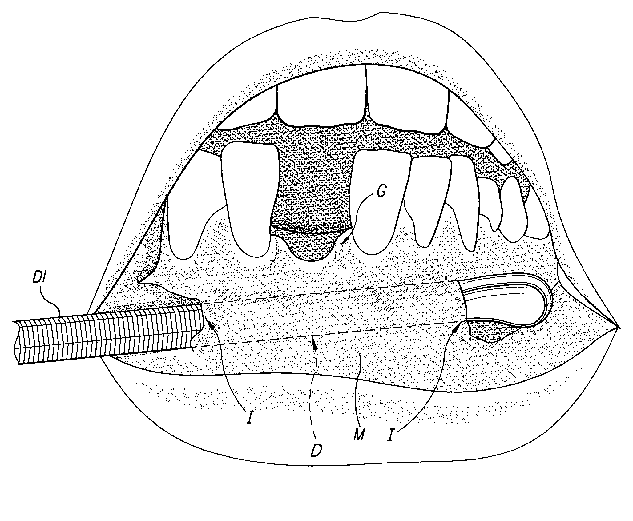 Tunneling method for dental block grafting