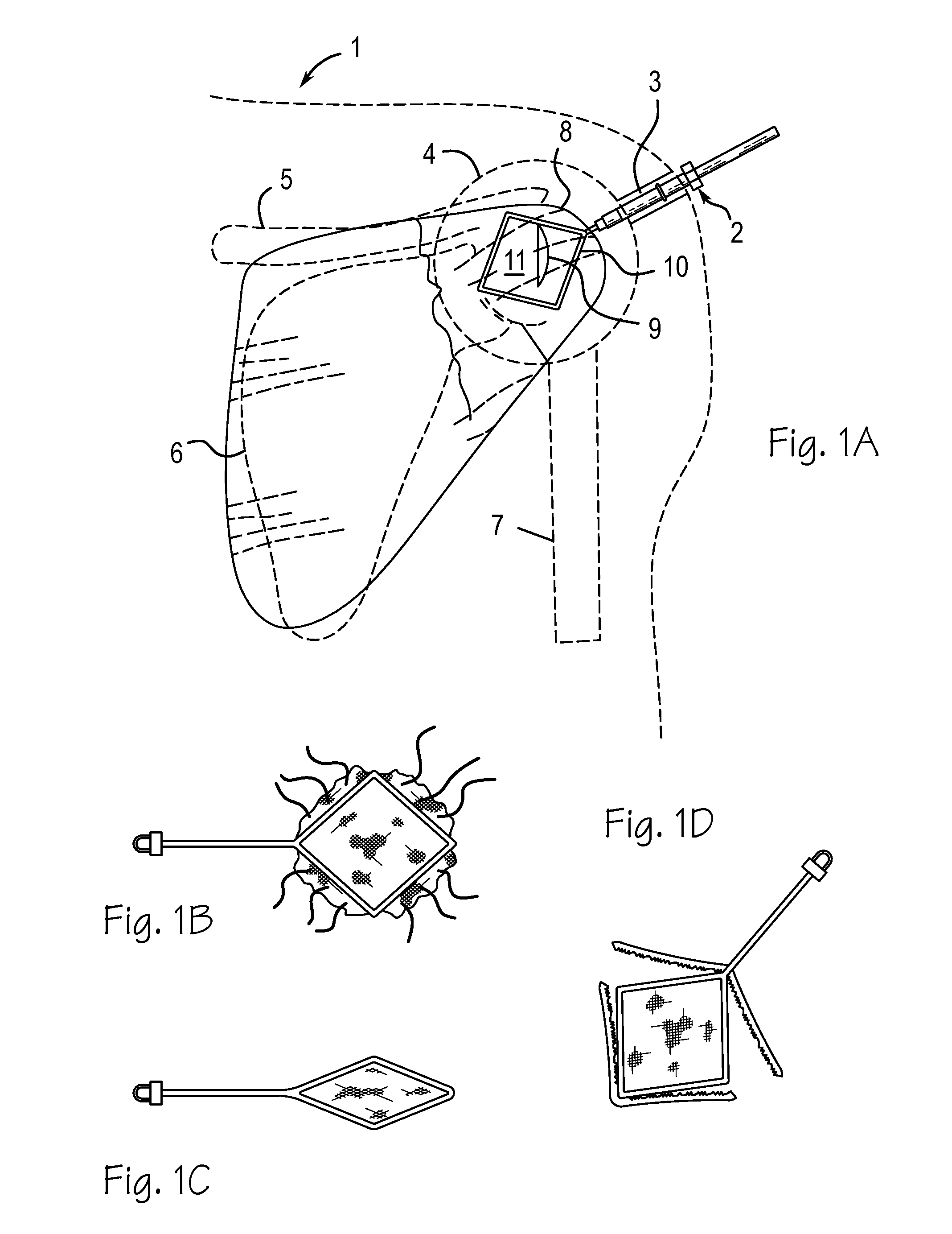 Method and devices for implantation of biologic constructs