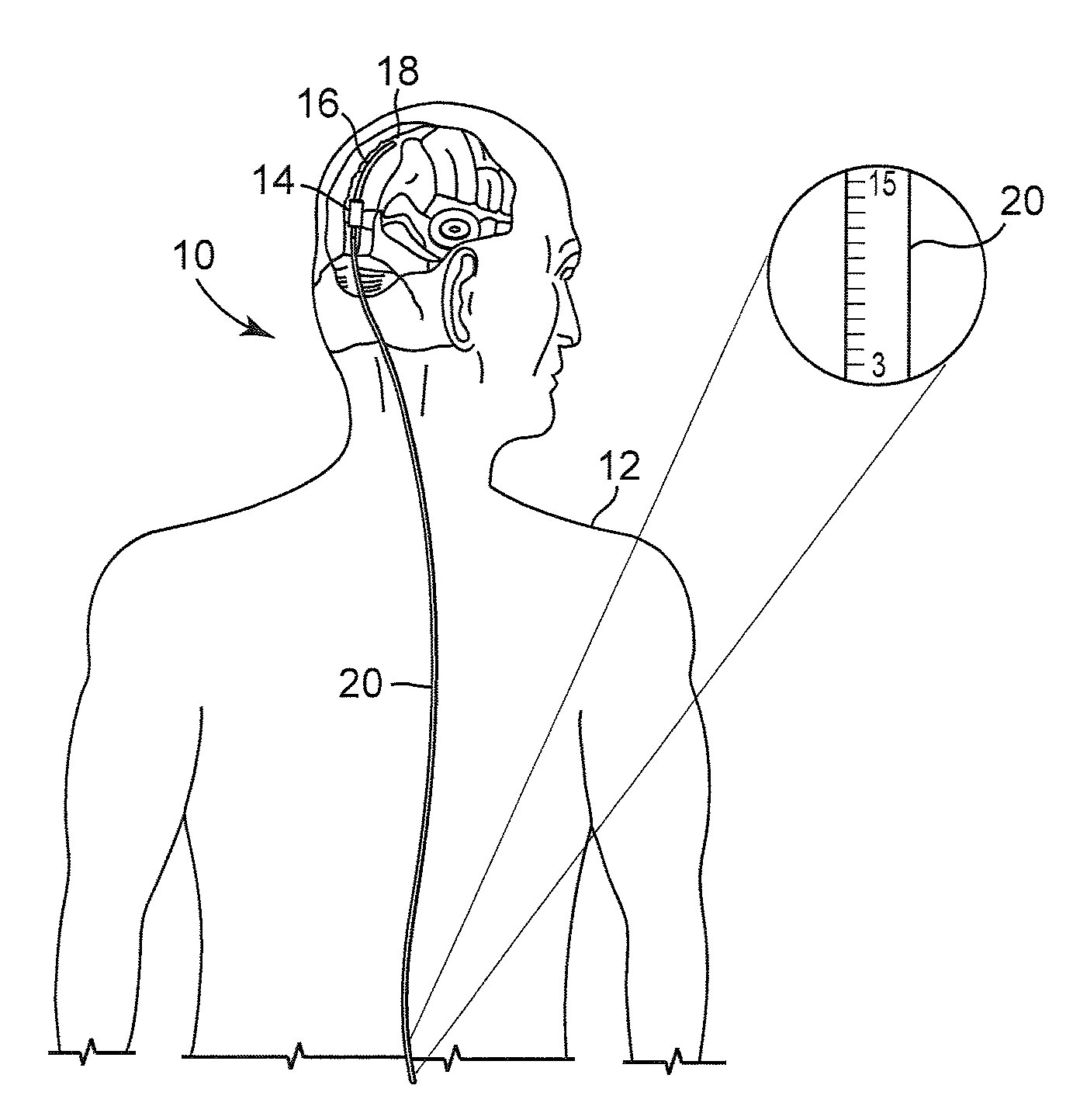 Implantable cerebrospinal fluid flow device and method of controlling flow of cerebrospinal fluid