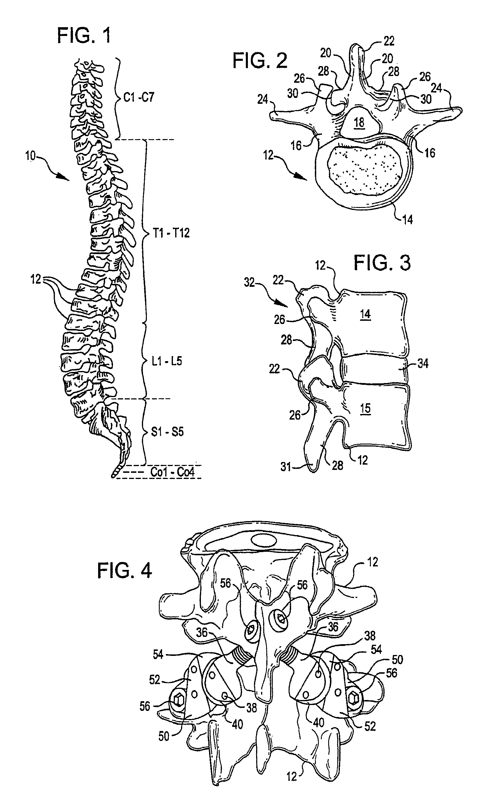 Crossbar spinal prosthesis having a modular design and systems for treating spinal pathologies