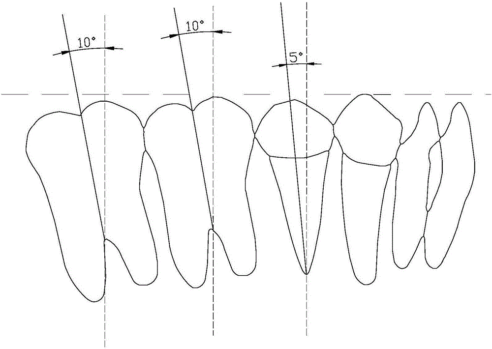 Molar anchorage control method for invisible orthodontic extraction cases