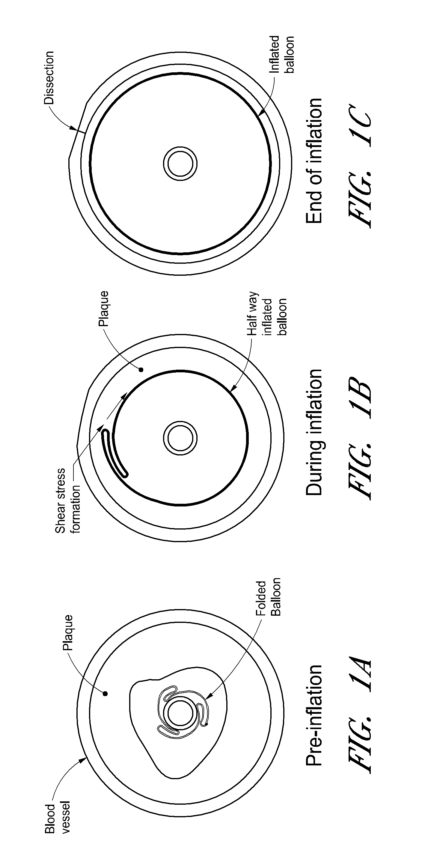 Device for compartmental dilatation of blood vessels