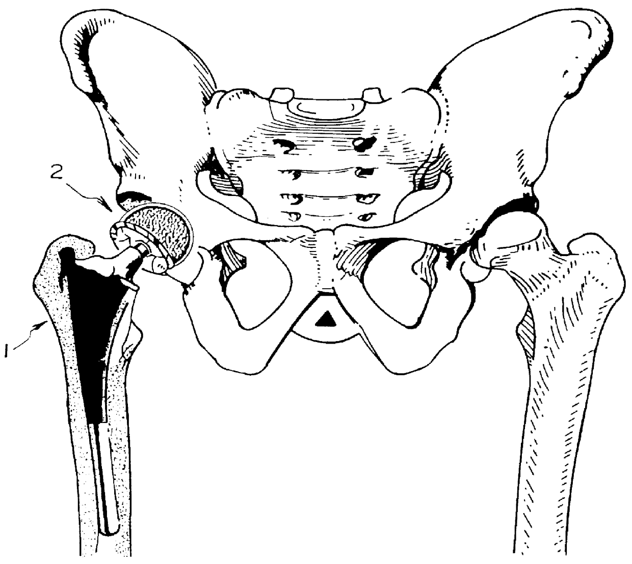 Orthopedic implant system
