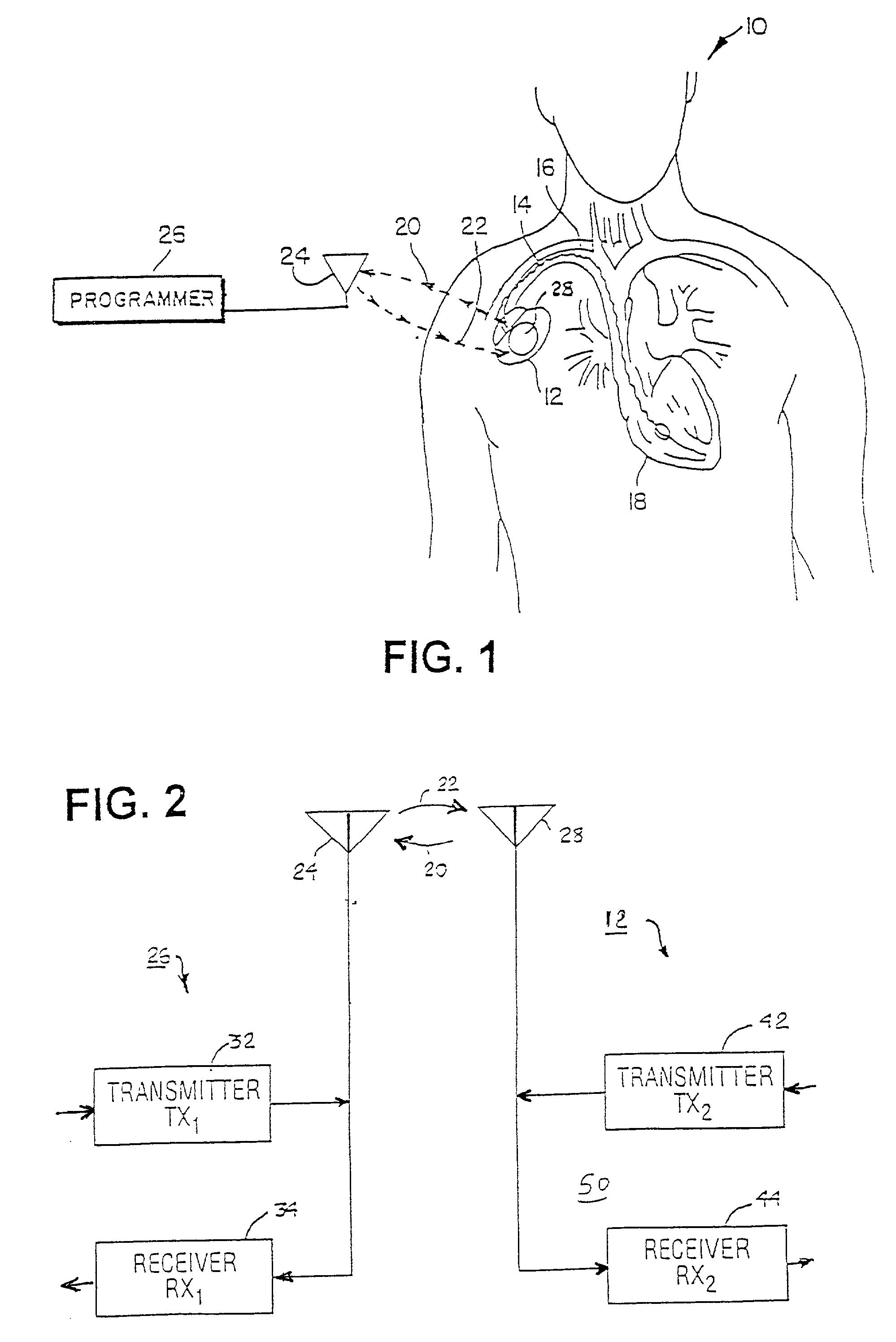 Implantable medical device incorporating integrated circuit notch filters