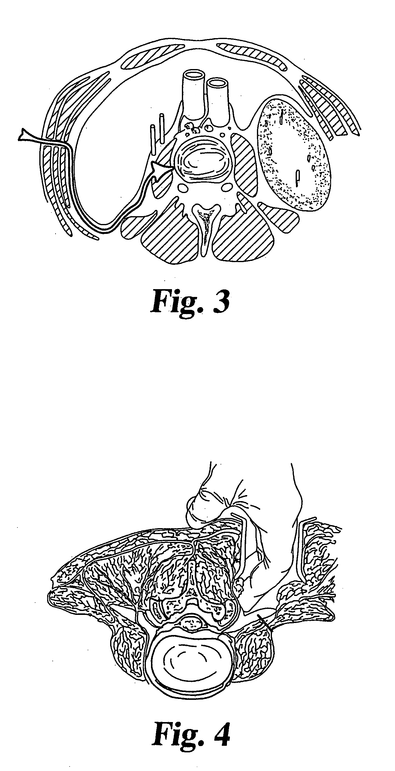Devices for injecting a curable biomaterial into a intervertebral space