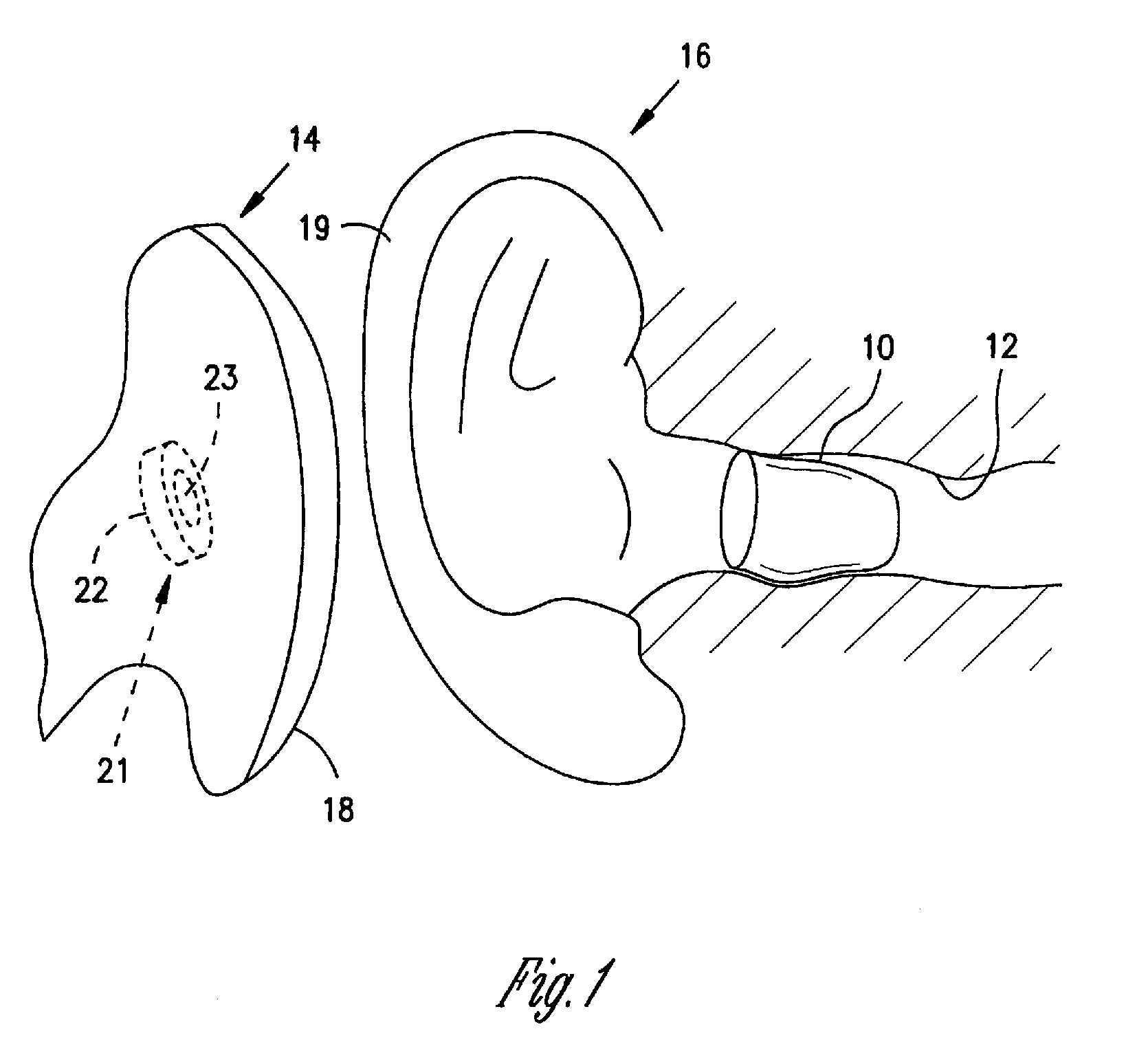 Switching structures for hearing assistance device