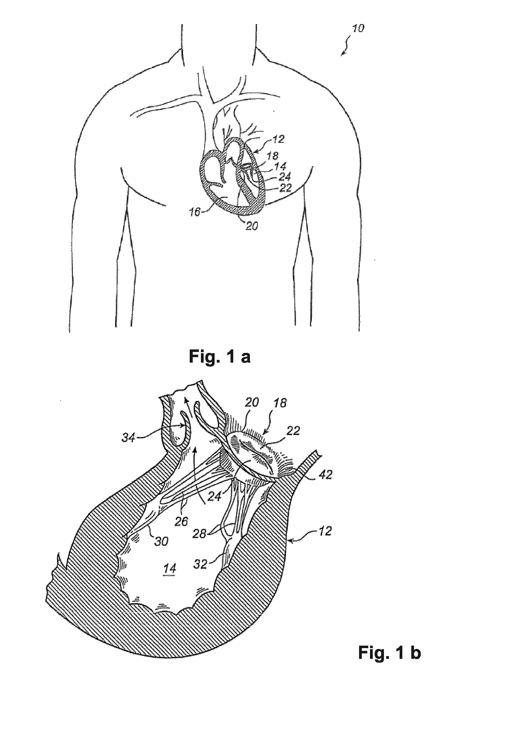 Device And Method For Improving Fixation Of A Medical Device