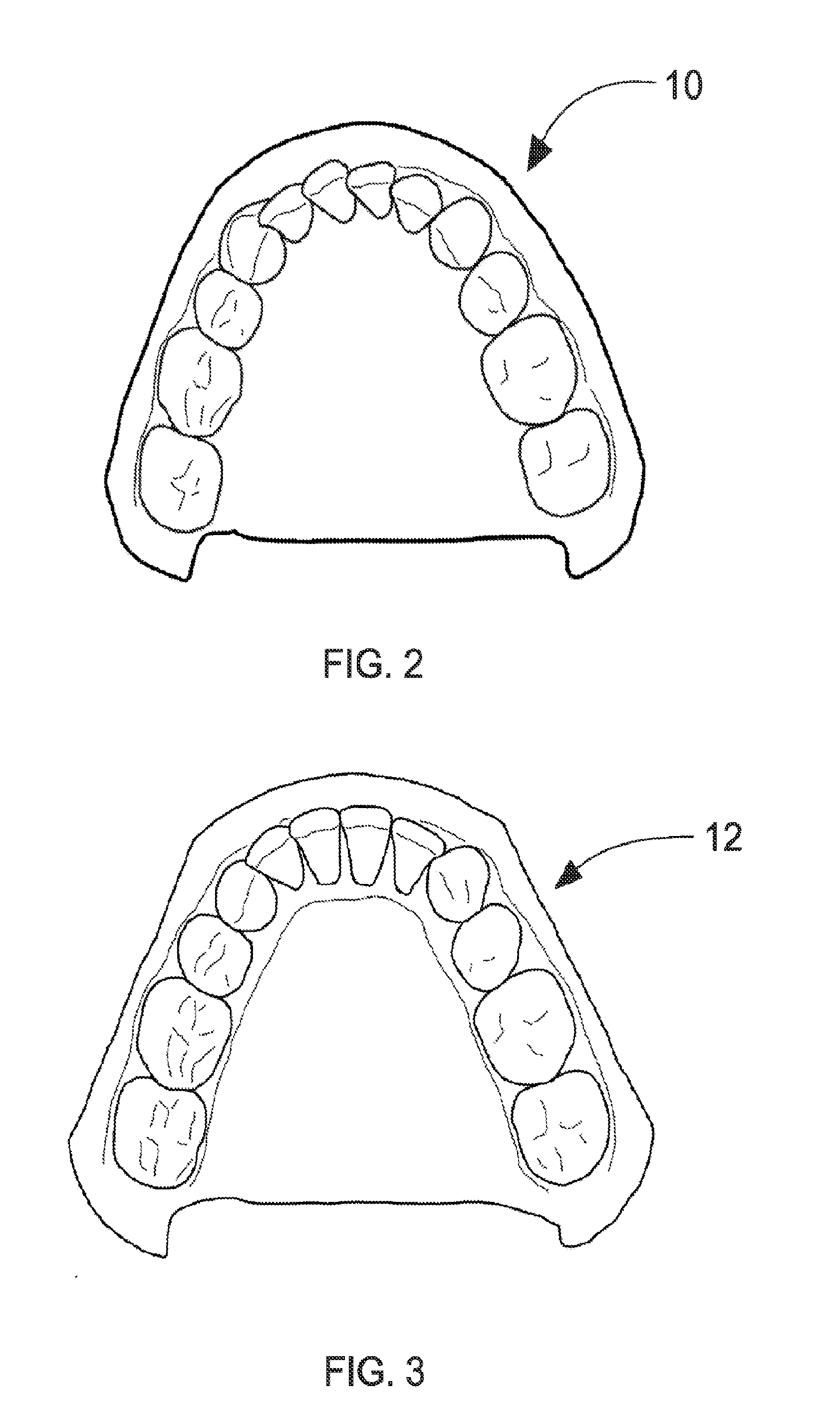 Orthodontic aligner fabrication by overlay method