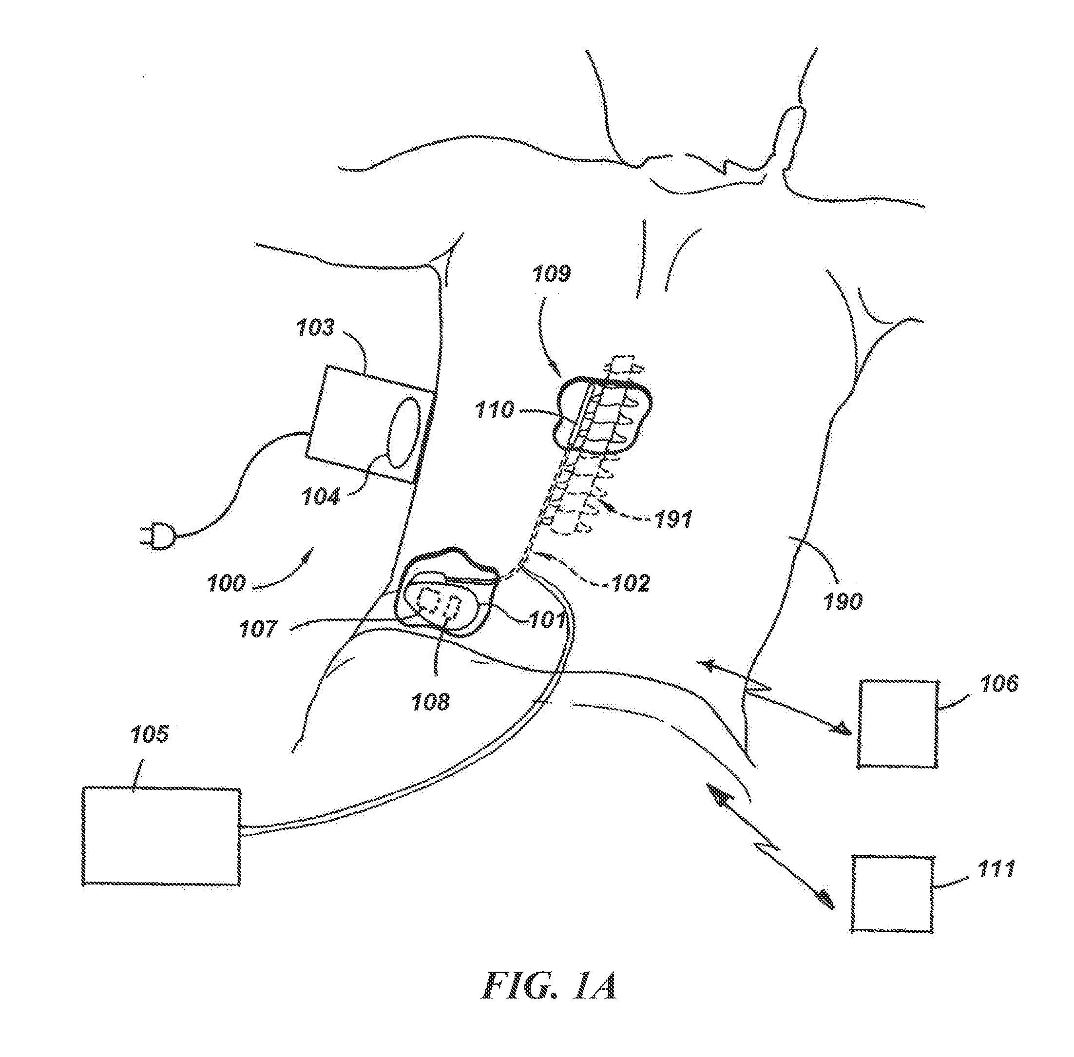Linked area parameter adjustment for spinal cord stimulation and associated systems and methods