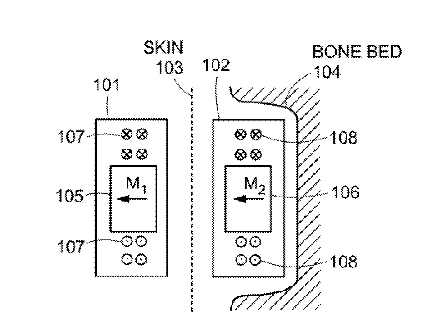 Magnetic Attachment System for Implantable Device
