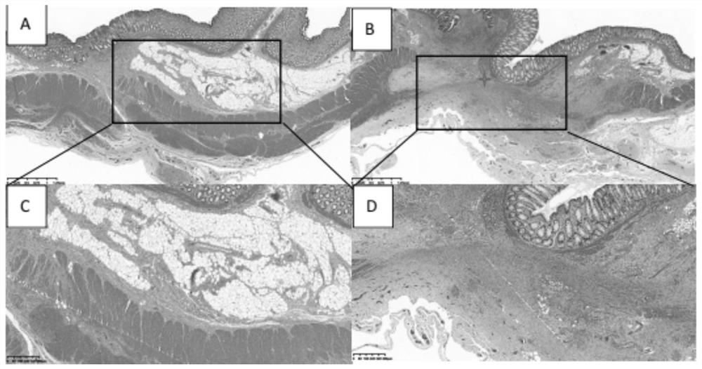 Implant for preventing anastomotic fistula