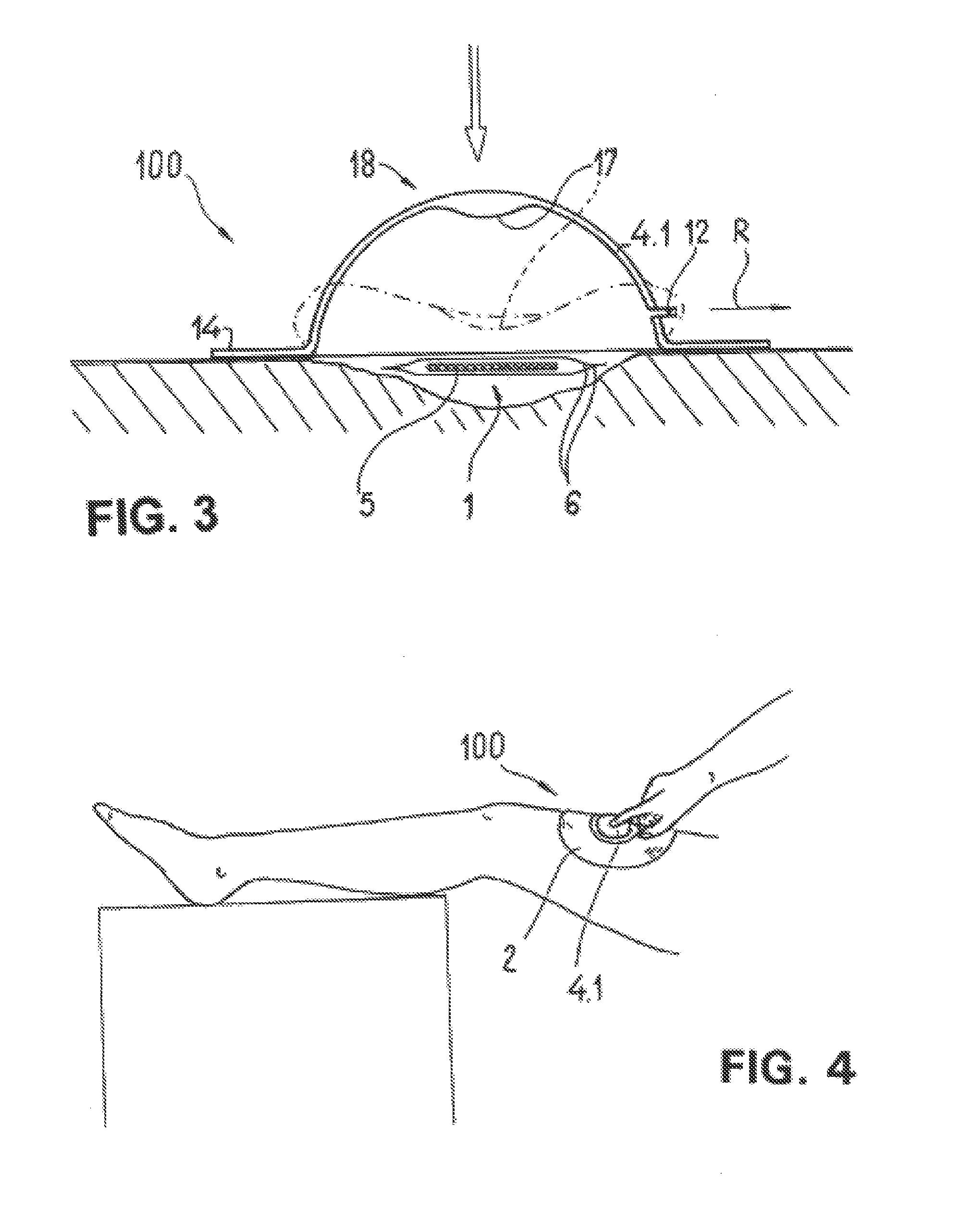 Wound treatment device with elastically deformable vacuum producing element