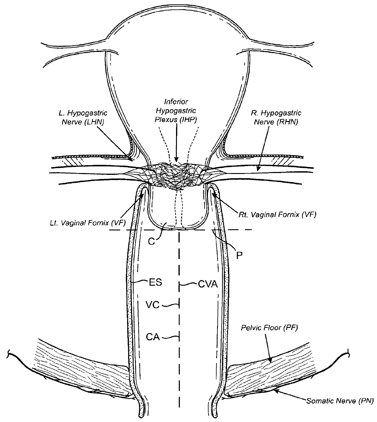 Devices and methods for stimulating nerves