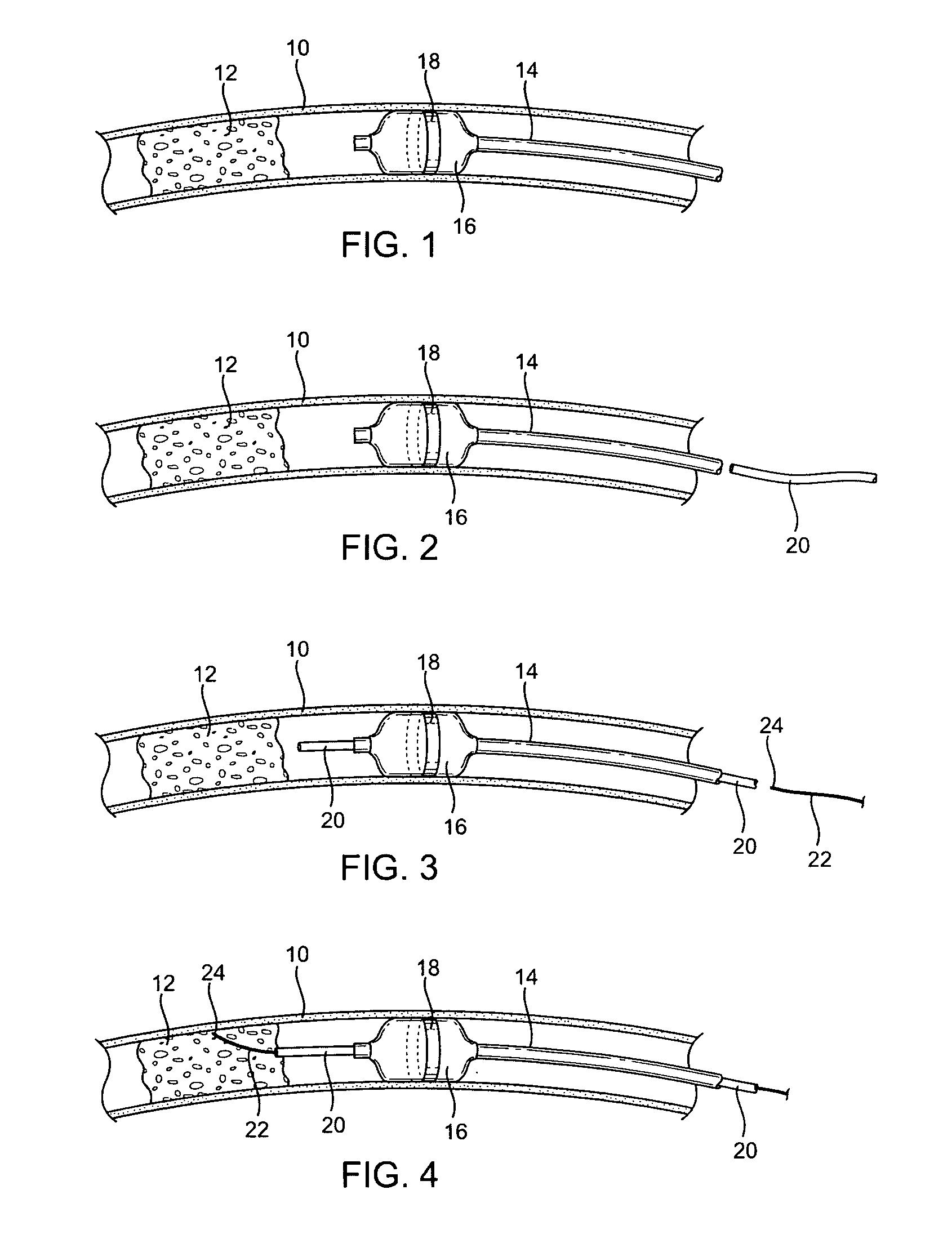 Intraluminal guidance system using bioelectric impedance