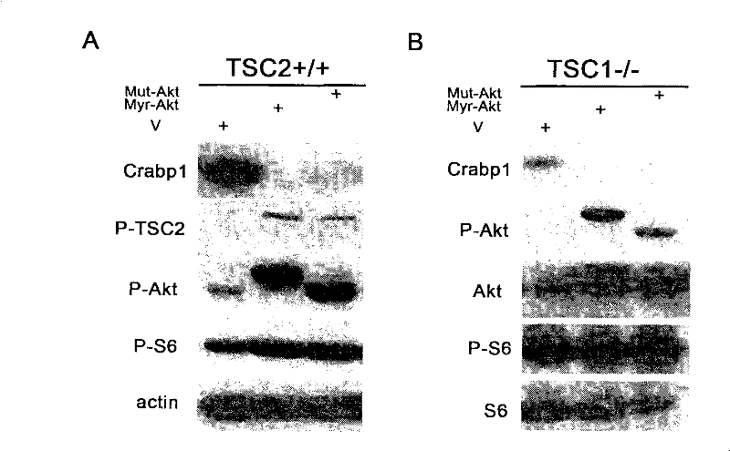 Retinoic acid and its analogs are used to treat tumors caused by tsc1/tsc2 inactivation or activation of its upstream pathway