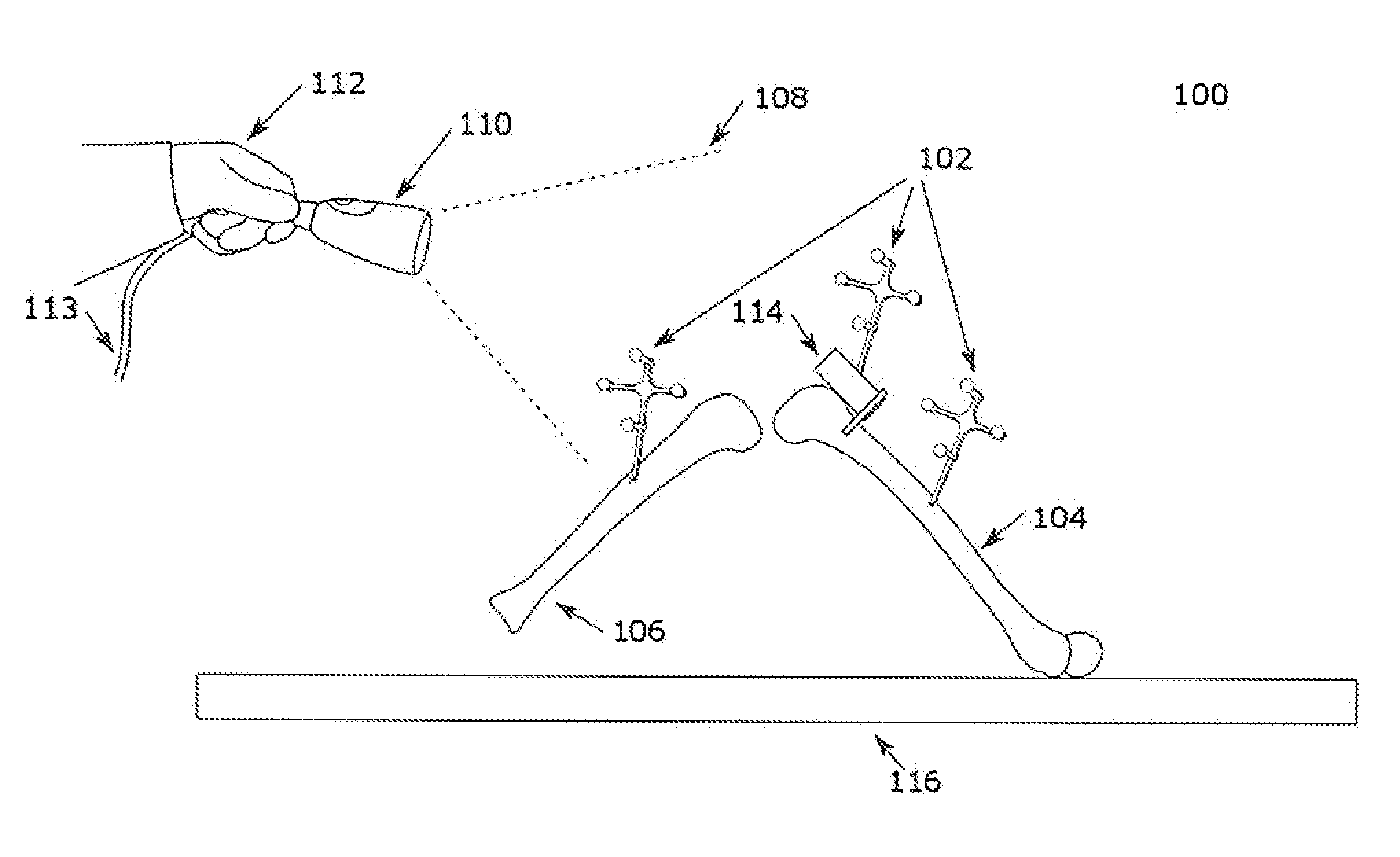 Surgical navigation system with one or more body borne components and method therefor