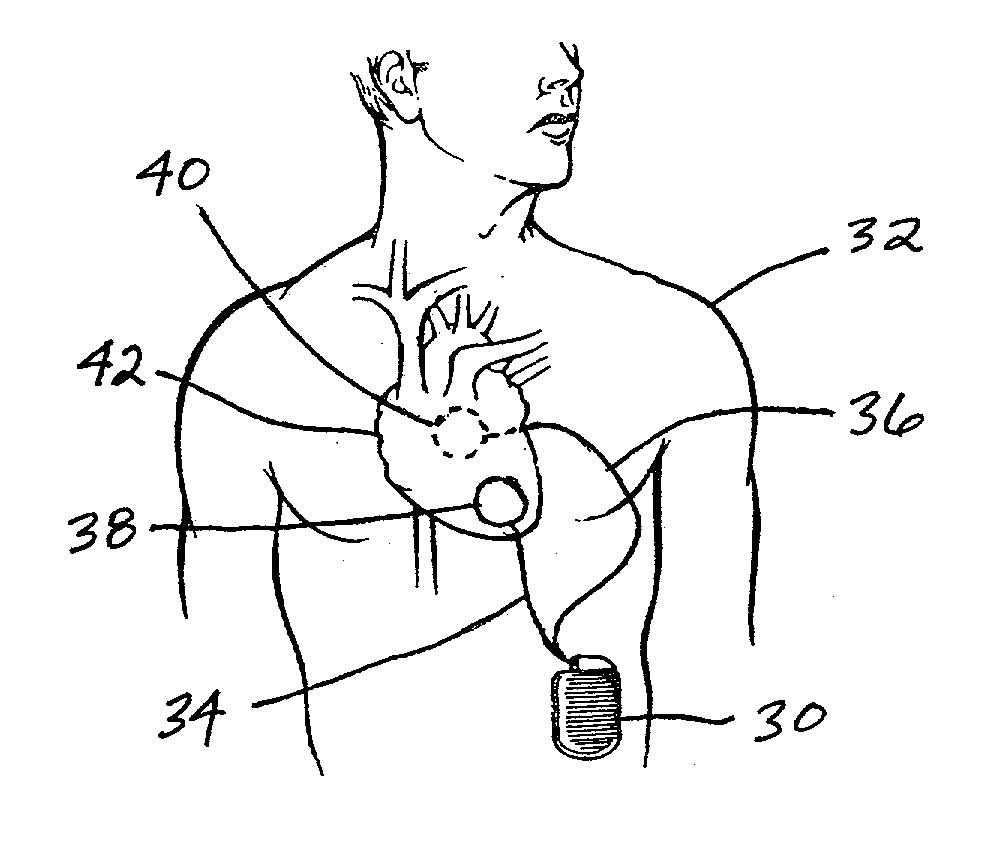 Implantable automatic defibrillator with subcutaneous electrodes